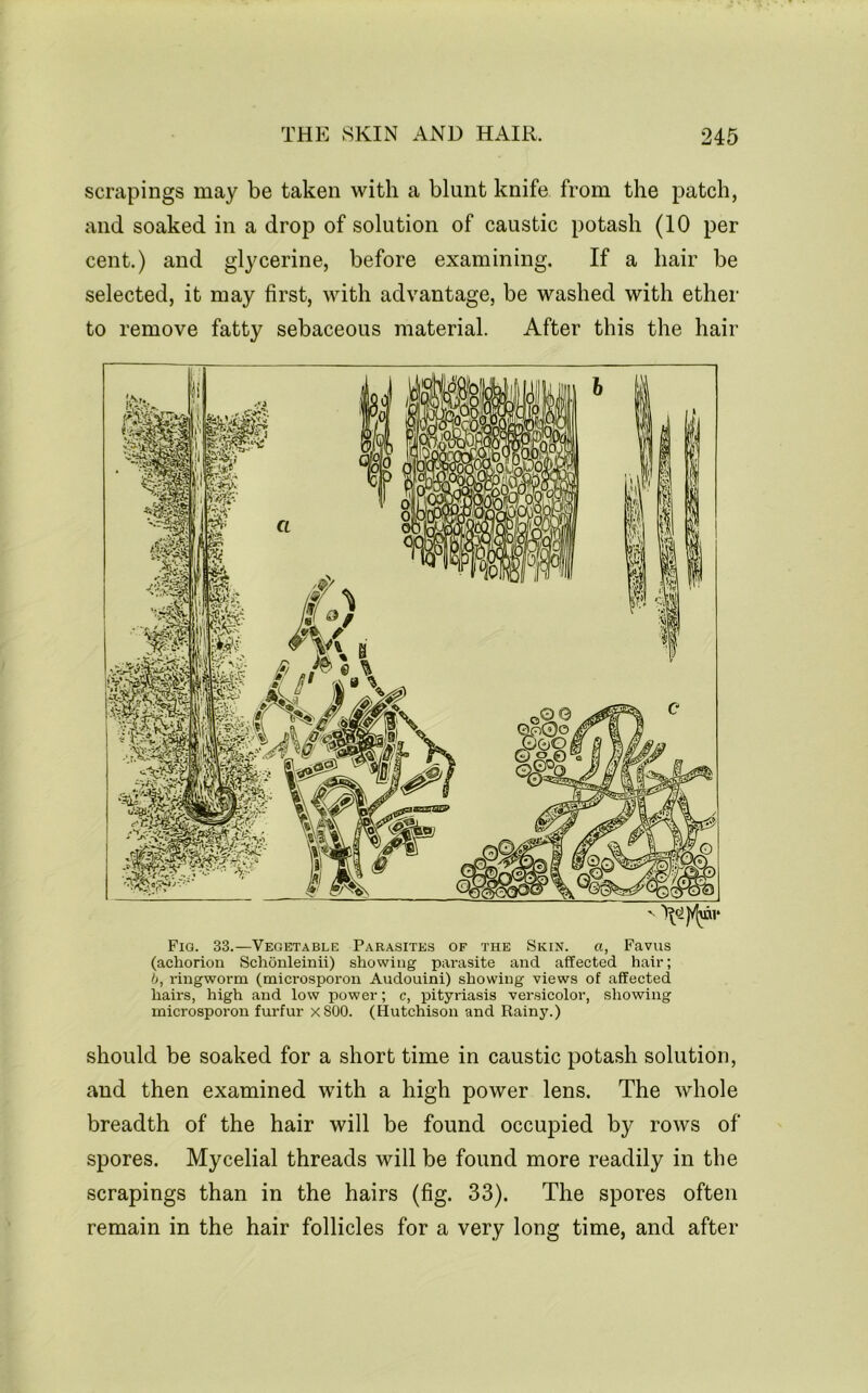 scrapings may be taken with a blunt knife from the patch, and soaked in a drop of solution of caustic potash (10 per cent.) and glycerine, before examining. If a hair be selected, it may first, with advantage, be washed with ether to remove fatty sebaceous material. After this the hair Fio. 33.—Vegetable Parasites of the Skin. a, Favus (achorion Schonleinii) showing parasite and affected hair; b, ringworm (microsporon Audouini) showing views of affected hairs, high and low power; c, pityriasis versicolor, showing microsporon furfur xSOO. (Hutchison and Rainy.) should be soaked for a short time in caustic potash solution, and then examined with a high power lens. The whole breadth of the hair will be found occupied by rows of spores. Mycelial threads will be found more readily in the scrapings than in the hairs (fig. 33). The spores often remain in the hair follicles for a very long time, and after