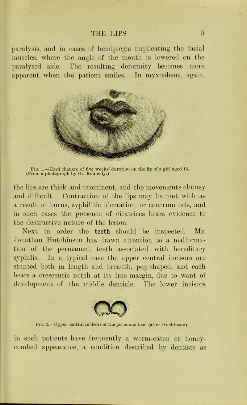 paralysis, and in cases of hemiplegia implicating the facial muscles, where the angle of the mouth is lowered on the paralysed side. The resulting deformity becomes more apparent when the patient smiles. In myxoedema, again, Fig. 1.—Hard chancre of five weeks’ duration on the lip of a girl aged 13. (From a photograph by Dr. Kennedy.) the lips are thick and prominent, and the movements clumsy and difficult. Contraction of the lips may he met with as a result of burns, syphilitic ulceration, or cancrum oris, and in such cases the presence of cicatrices bears evidence to the destructive nature of the lesion. Next in order the teeth should be inspected. Mr. Jonathan Hutchinson has drawn attention to a malforma- tion of the permanent teeth associated with hereditary syphilis. In a typical case the upper central incisors are stunted both in length and breadth, peg-shaped, and each bears a crescentic notch at its free margin, due to want of development of the middle denticle. The lower incisors Fig. 2.—Upper central incisors of the permanent set (after Hucliinson). in such patients have frecpiently a worm-eaten or honey- combed appearance, a condition described by dentists as