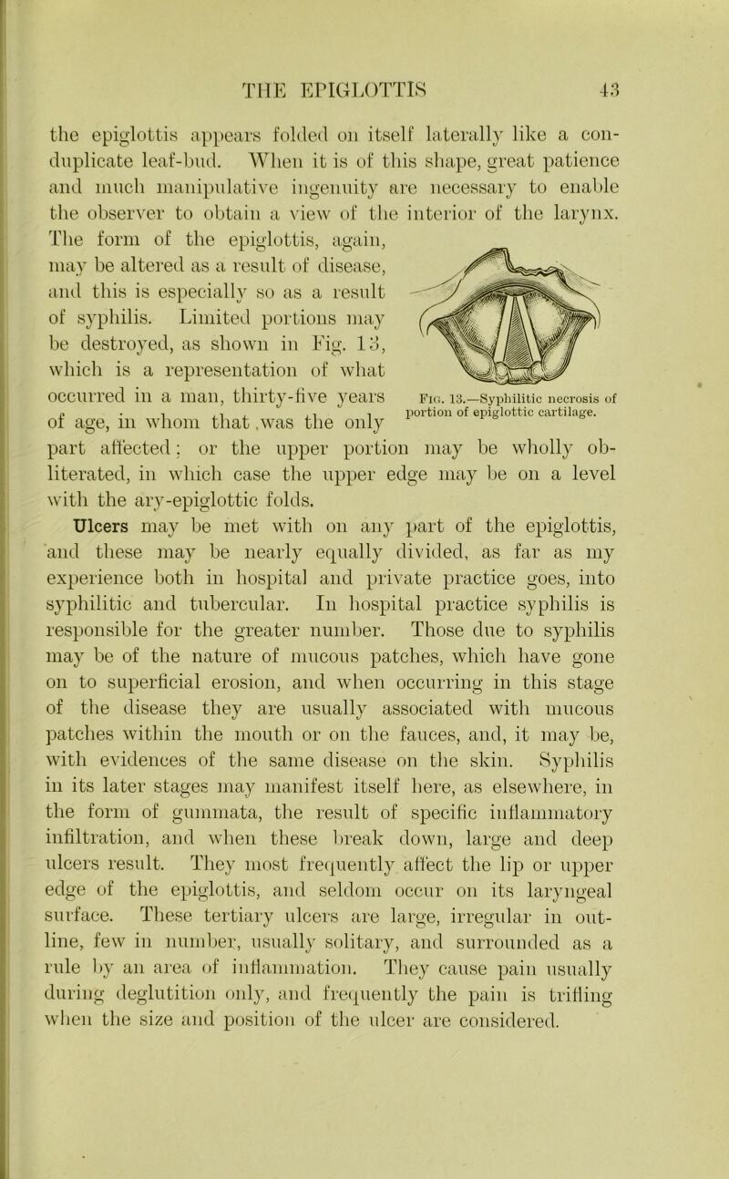 the epiglottis appears folded on itself laterally like a con- duplicate leaf-bud. When it is of this shape, great patience and much manipulative ingenuity are necessary to enable the observer to obtain a view of the interior of the larynx. The form of the epiglottis, again, may be altered as a result of disease, and this is especially so as a result of syphilis. Limited portions may be destroyed, as shown in Fig. 13, which is a representation of what occurred in a man, thirty-five years of age, in whom that .was the only part affected: or the upper portion may be wholly ob- literated, in which case the upper edge may he on a level with the ary-epiglottic folds. Ulcers may be met with on any part of the epiglottis, and these may be nearly equally divided, as far as my experience both in hospital and private practice goes, into syphilitic and tubercular. In hospital practice syphilis is responsible for the greater number. Those due to syphilis may be of the nature of mucous patches, which have gone on to superficial erosion, and when occurring in this stage of the disease they are usually associated with mucous patches within the mouth or on the fauces, and, it may be, with evidences of the same disease on the skin. Syphilis in its later stages may manifest itself here, as elsewhere, in the form of giunmata, the result of specific inflammatory infiltration, and when these break down, large and deep ulcers result. They most frequently affect the lip or upper edge of the epiglottis, and seldom occur on its laryngeal surface. These tertiary ulcers are large, irregular in out- line, few in number, usually solitary, and surrounded as a rule by an area of inflammation. They cause pain usually during deglutition only, and frequently the pain is trifling when the size and position of the ulcer are considered. Fig. 13.—Syphilitic necrosis of portion of epiglottic cartilage.