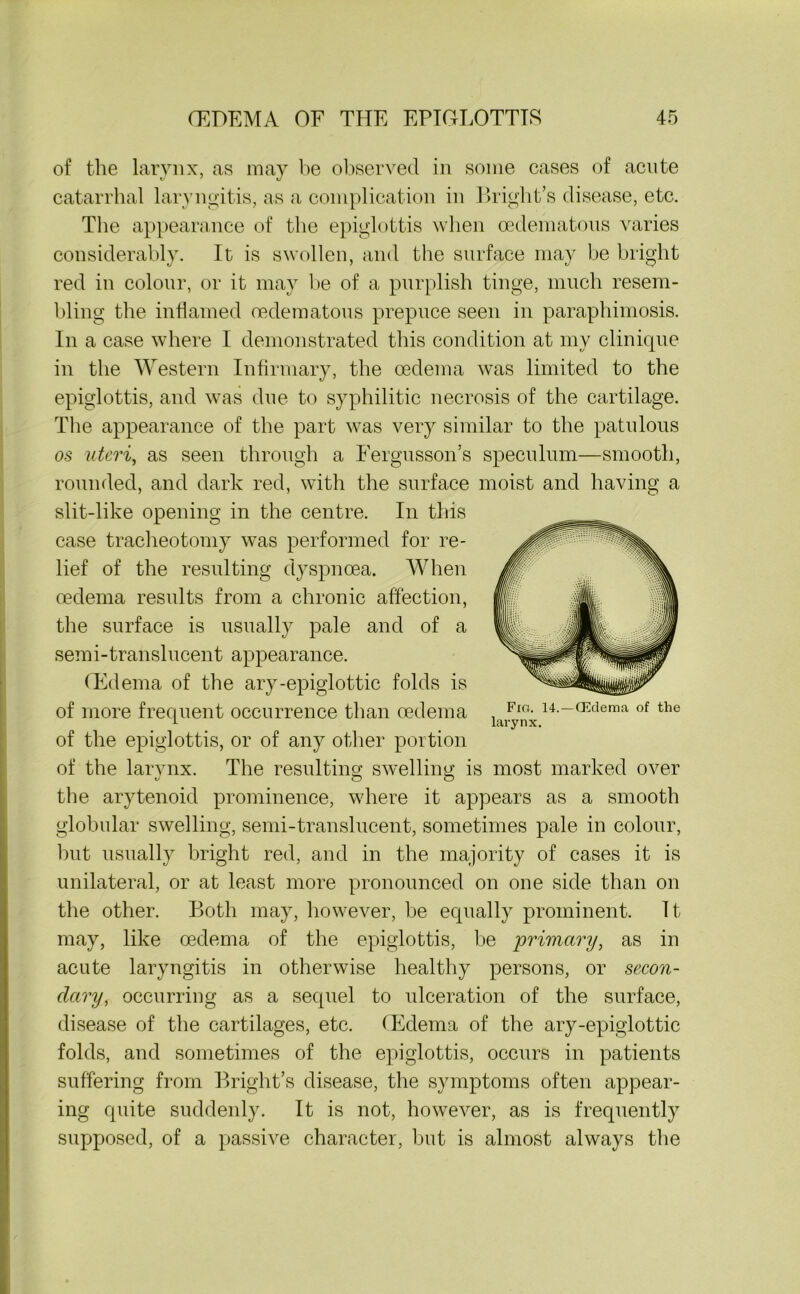 of the larynx, as may he observed in some cases of acute The appearance of the epiglottis when cedematous varies considerably. It is swollen, and the surface may be bright red in colour, or it may be of a purplish tinge, much resem- bling the inflamed cedematous prepuce seen in paraphimosis. In a case where I demonstrated this condition at my clinique in the Western Infirmary, the oedema was limited to the epiglottis, and was due to syphilitic necrosis of the cartilage. The appearance of the part was very similar to the patulous os uteri, as seen through a Fergusson’s speculum—smooth, rounded, and dark red, with the surface moist and having a slit-like opening in the centre. In this case tracheotomy was performed for re- lief of the resulting dyspnoea. When oedema results from a chronic affection, the surface is usually pale and of a semi-translucent appearance. (Edema of the ary-epiglottic folds is of more frequent occurrence than oedema of the epiglottis, or of any other portion of the larynx. The resulting; swelling is most marked over the arytenoid prominence, where it appears as a smooth globular swelling, semi-translucent, sometimes pale in colour, but usually bright red, and in the majority of cases it is unilateral, or at least more pronounced on one side than on the other. Both may, however, be equally prominent. It may, like oedema of the epiglottis, be primary, as in acute laryngitis in otherwise healthy persons, or secon- dary, occurring as a sequel to ulceration of the surface, disease of the cartilages, etc. (Edema of the ary-epiglottic folds, and sometimes of the epiglottis, occurs in patients suffering from Bright’s disease, the symptoms often appear- ing quite suddenly. It is not, however, as is frequently supposed, of a passive character, but is almost always the