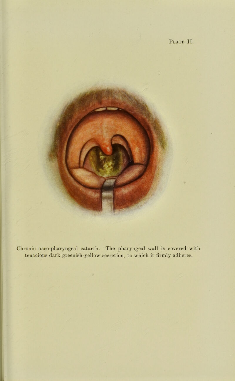 Plate II. Chronic naso-pharyngeal catarrh. The pharyngeal wall is covered with tenacious dark greenish-yellow' secretion, to which it firmly adheres. li