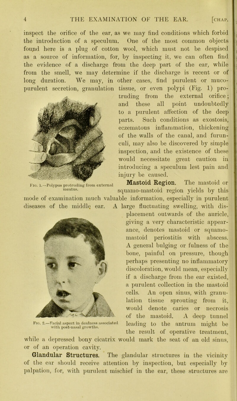 Fig. 1.—Polypus protruding from external meatus. inspect the orifice of the ear, as we may find conditions which forbid the introduction of a speculum. One of the most common objects foujid here is a plug of cotton wool, which must not be despised as a source of information, for, by inspecting it, we can often find the evidence of a discharge from the deep part of the ear, while from the smell, we may determine if the discharge is recent or of long duration. We may, in other cases, find purulent or muco- purulent secretion, granulation tissue, or even polypi (Fig. 1) pro- truding from the external orifice; and these all point undoubtedly to a purulent affection of the deep parts. Such conditions as exostosis, eczematous inflammation, thickening of the walls of the canal, and furun- culi, may also be discovered by simple inspection, and the existence of these would necessitate great caution in introducing a speculum lest pain and injury be caused. Mastoid Region. The mastoid or squamo-mastoid region yields by this mode of examination much valuable information, especially in purulent diseases of the middle ear. A large fluctuating swelling, with dis- placement outwards of the auricle, giving a very characteristic appear- ance, denotes mastoid or squamo- mastoid periostitis with abscess. A general bulging or fulness of the bone, painful on pressure, though perhaps presenting no inflammatory discoloration, would mean, especially if a discharge from the ear existed, a purulent collection in the mastoid cells. An open sinus, with granu- lation tissue sprouting from it, would denote caries or necrosis of the mastoid. A deep tunnel leading to the antrum might be the result of operative treatment, while a depressed bony cicatrix would mark the seat of an old sinus, or of an operation cavity. Glandular Structures. The glandular structures in the vicinity of the ear should receive attention by inspection, but especially by palpation, for, with purulent mischief in the ear, these structures are Fig. 2.—Facial aspect in deafness associated with post-nasal growths.