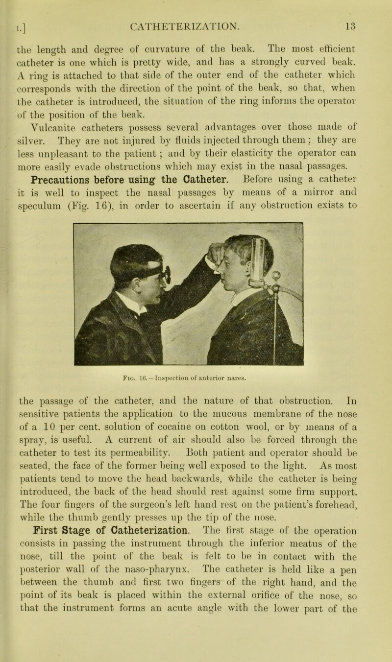 >•] the length and degree of curvature of the beak. The most efficient catheter is one which is pretty wide, and has a strongly curved beak. A ring is attached to that side of the outer end of the catheter which corresponds with the direction of the point of the beak, so that, when the catheter is introduced, the situation of the ring informs the operator of the position of the beak. Vulcanite catheters possess several advantages over those made ol silver. They are not injured by fluids injected through them ; they are less unpleasant to the patient ; and by their elasticity the operator can more easily evade obstructions which may exist in the nasal passages. Precautions before using the Catheter. Before using a catheter it is well to inspect the nasal passages by means of a mirror and speculum (Fig. 16), in order to ascertain if any obstruction exists to Fig. 16. —Inspection of anterior nares. the passage of the catheter, and the nature of that obstruction. In sensitive patients the application to the mucous membrane of the nose of a 10 per cent, solution of cocaine on cotton wool, or by means of a spray, is useful. A current of air should also be forced through the catheter to test its permeability. Both patient and operator should be seated, the face of the former being well exposed to the light. As most patients tend to move the head backwards, while the catheter is being introduced, the back of the head should rest against some firm support. The four fingers of the surgeon’s left hand rest on the patient’s forehead, while the thumb gently presses up the tip of the nose. First Stage of Catheterization. The first stage of the operation consists in passing the instrument through the inferior meatus of the nose, till the point of the beak is felt to be in contact with the posterior wall of the naso-pharynx. The catheter is held like a pen between the thumb and first two fingers of the right hand, and the point of its beak is placed within the external orifice of the nose, so that the instrument forms an acute angle with the lower part of the