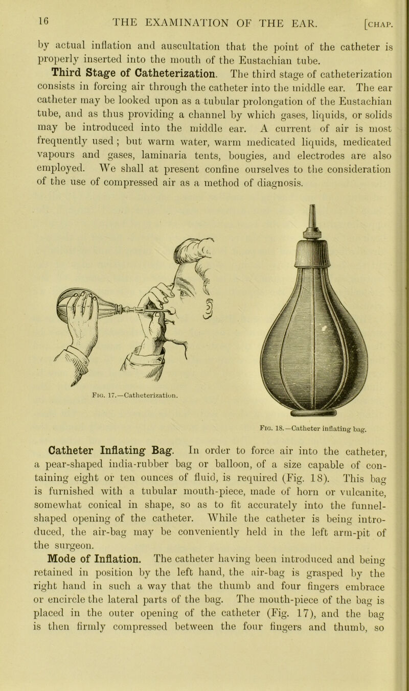 by actual inflation and auscultation that the point of the catheter is properly inserted into the mouth of the Eustachian tube. Third Stage of Catheterization. The third stage of catheterization consists in forcing air through the catheter into the middle ear. The ear catheter may be looked upon as a tubular prolongation of the Eustachian tube, and as thus providing a channel by which gases, liquids, or solids may be introduced into the middle ear. A current of air is most frequently used ; but warm water, warm medicated liquids, medicated vapours and gases, laminaria tents, bougies, and electrodes are also employed. We shall at present confine ourselves to the consideration of the use of compressed air as a method of diagnosis. Fig. 18.—Catheter inflating bag. Catheter Inflating Bag. In order to force air into the catheter, a pear-shaped india-rubber bag or balloon, of a size capable of con- taining eight or ten ounces of fluid, is required (Fig. 18). This bag is furnished with a tubular mouth-piece, made of horn or vulcanite, somewhat conical in shape, so as to fit accurately into the funnel- shaped opening of the catheter. While the catheter is being intro- duced, the air-bag may be conveniently held in the left arm-pit of the surgeon. Mode of Inflation. The catheter having been introduced and beino- retained in position by the left hand, the air-bag is grasped by the right hand in such a way that the thumb and four fingers embrace or encircle the lateral parts of the bag. The mouth-piece of the bag is placed in the outer opening of the catheter (Fig. 17), and the bag is then firmly compressed between the four fingers and thumb, so