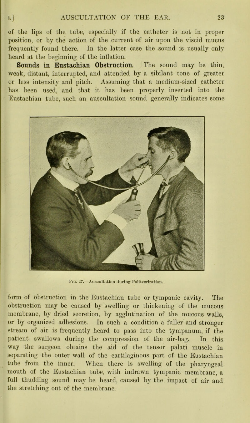 of the lips of the tube, especially if the catheter is not in proper position, or by the action of the current of air upon the viscid mucus frequently found there. In the latter case the sound is usually only heard at the beginning of the inflation. Sounds in Eustachian Obstruction. The sound may be thin, weak, distant, interrupted, and attended by a sibilant tone of greater or less intensity and pitch. Assuming that a medium-sized catheter has been used, and that it has been properly inserted into the Eustachian tube, such an auscultation sound generally indicates some Fig. 27.—Auscultation during Politzerization. form of obstruction in the Eustachian tube or tympanic cavity. The obstruction may be caused by swelling or thickening of the mucous membrane, by dried secretion, by agglutination of the mucous walls, or by organized adhesions. In such a condition a fuller and stronger stream of air is frequently heard to pass into the tympanum, if the patient swallows during the compression of the air-bag. In this way the surgeon obtains the aid of the tensor palati muscle in separating the outer wall of the cartilaginous part of the Eustachian tube from the inner. When there is swelling of the pharyngeal mouth of the Eustachian tube, with indrawn tympanic membrane, a full thudding sound may be heard, caused by the impact of air and the stretching out of the membrane.