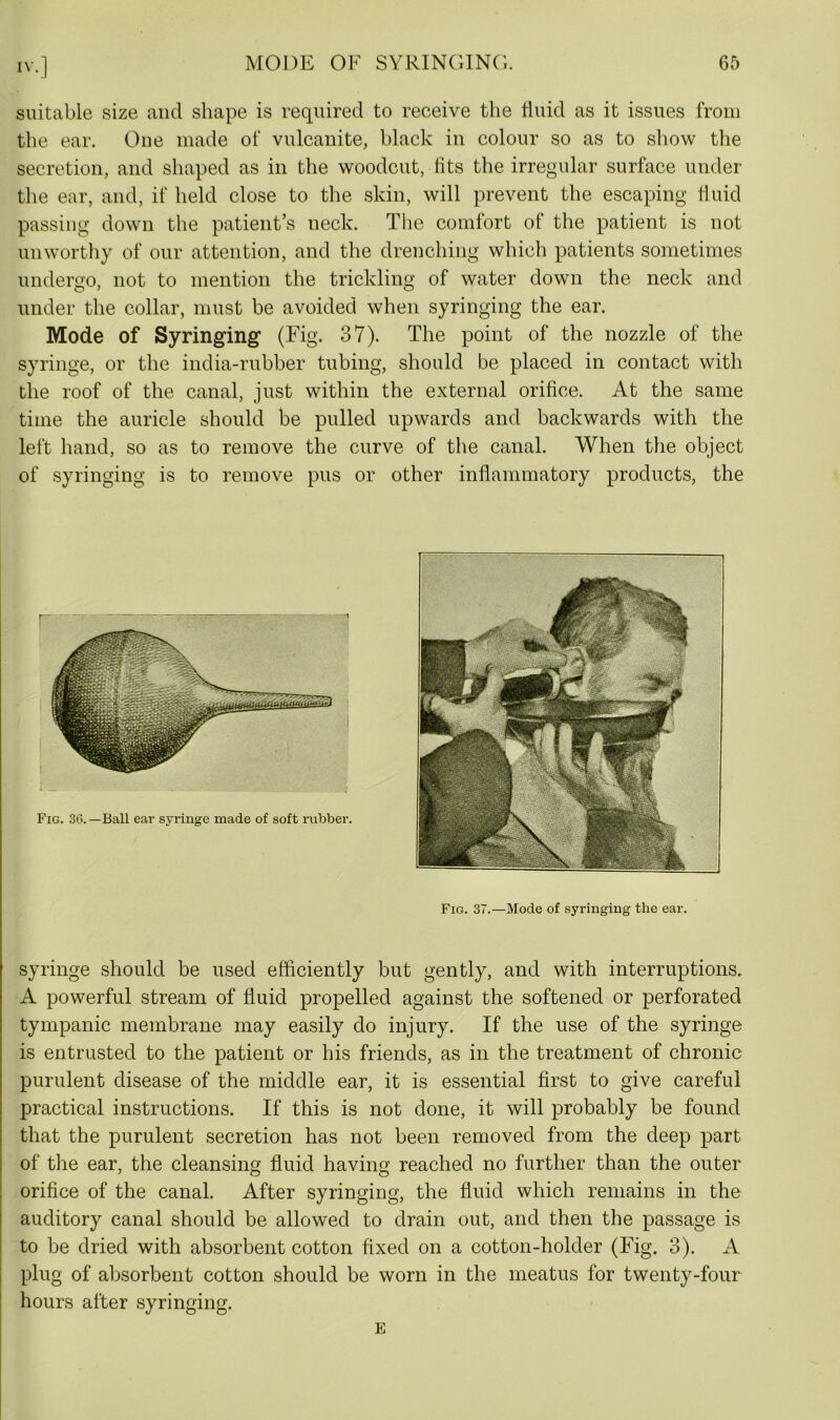 suitable size and shape is required to receive the fluid as it issues from the ear. One made of vulcanite, black in colour so as to show the secretion, and shaped as in the woodcut, fits the irregular surface under the ear, and, if held close to the skin, will prevent the escaping fluid passing down the patient’s neck. The comfort of the patient is not unworthy of our attention, and the drenching which patients sometimes undergo, not to mention the trickling of water down the neck and under the collar, must be avoided when syringing the ear. Mode of Syringing (Fig. 37). The point of the nozzle of the syringe, or the india-rubber tubing, should be placed in contact with the roof of the canal, just within the external orifice. At the same time the auricle should be pulled upwards and backwards with the left hand, so as to remove the curve of the canal. When the object of syringing is to remove pus or other inflammatory products, the r Fig. 36.—Ball ear syringe made of soft rubber. Fig. 37.—Mode of syringing the ear. syringe should be used efficiently but gently, and with interruptions. A powerful stream of fluid propelled against the softened or perforated tympanic membrane may easily do injury. If the use of the syringe is entrusted to the patient or his friends, as in the treatment of chronic purulent disease of the middle ear, it is essential first to give careful practical instructions. If this is not done, it will probably be found that the purulent secretion has not been removed from the deep part of the ear, the cleansing fluid having reached no further than the outer orifice of the canal. After syringing, the fluid which remains in the auditory canal should be allowed to drain out, and then the passage is to be dried with absorbent cotton fixed on a cotton-holder (Fig. 3). A plug of absorbent cotton should be worn in the meatus for twenty-four hours after syringing.