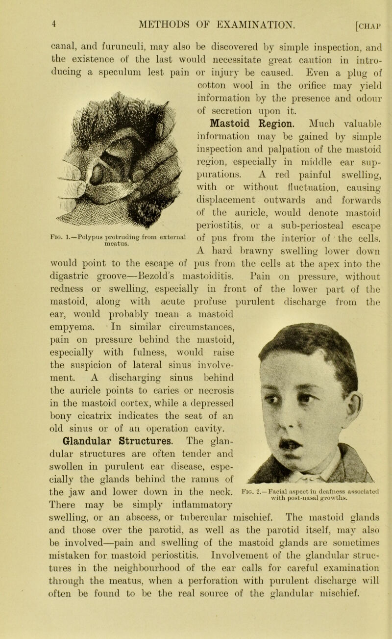 Fig. 1.—Polypus protruding from external meatus. canal, and furunculi, may also be discovered by simple inspection, and the existence of the last would necessitate great caution in intro- ducing a speculum lest pain or injury be caused. Even a plug of cotton wool in the orifice may yield information by the presence and odour of secretion upon it. Mastoid Region. Much valuable information may be gained by simple inspection and palpation of the mastoid region, especially in middle ear sup- purations. A red painful swelling, with or without fluctuation, causing; displacement outwards and forwards of the auricle, would denote mastoid periostitis, or a sub-periosteal escape of pus from the interior of the cells. A hard brawny swelling lower down would point to the escape of pus from the cells at the apex into the digastric groove—Bezold’s mastoiditis. Pain on pressure, without redness or swelling, especially in front of the lower part pf the mastoid, along with acute profuse purulent discharge from the ear, would probably mean a mastoid empyema. In similar circumstances, pain on pressure behind the mastoid, especially with fulness, would raise the suspicion of lateral sinus involve- ment. A discharging sinus behind the auricle points to caries or necrosis in the mastoid cortex, while a depressed bony cicatrix indicates the seat of an old sinus or of an operation cavity. Glandular Structures. The glan- dular structures are often tender and swollen in purulent ear disease, espe- cially the glands behind the ramus of the jaw and lower down in the neck. Fig. 2.— Facial aspect iu deafness associated ' with post-nasal growths. There may be simply inflammatory swelling, or an abscess, or tubercular mischief. The mastoid glands and those over the parotid, as well as the parotid itself, may also be involved—pain and swelling of the mastoid glands are sometimes mistaken for mastoid periostitis. Involvement of the glandular struc- tures in the neighbourhood of the ear calls for careful examination through the meatus, when a perforation with purulent discharge will often be found to be the real source of the glandular mischief.