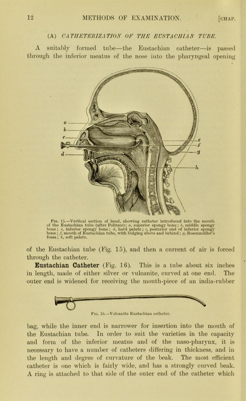 (A) CATHETERIZATION OF THE EUSTACHIAN TUBE. A suitably formed tube—the Eustachian catheter—is passed through the inferior meatus of the nose into the pharyngeal opening Fig. 15.—Vertical section of head, showing catheter introduced into the mouth of the Eustachian tube (after Politzer); a. superior spongy bone; b, middle spongy bone ; c, inferior spongy bone ; cl, hard palate ; e, posterior end of inferior spongy bone ; mouth of Eustachian tube, with bulging above and behind ; g, Rosenmiiller’s fossa ; h, soft palate. of the Eustachian tube (Fig. 15), and then a current of air is forced through the catheter. Eustachian Catheter (Fig. 16). This is a tube about six inches in length, made of either silver or vulcanite, curved at one end. The outer end is widened for receiving the mouth-piece of an india-rubber bag;, while the inner end is narrower for insertion into the mouth of the Eustachian tube. In order to suit the varieties in the capacity and form of the inferior meatus and of the naso-pharynx, it is necessary to have a number of catheters differing in thickness, and in the length and degree of curvature of the beak. The most efficient catheter is one which is fairly wide, and has a strongly curved beak. A ring is attached to that side of the outer end of the catheter which