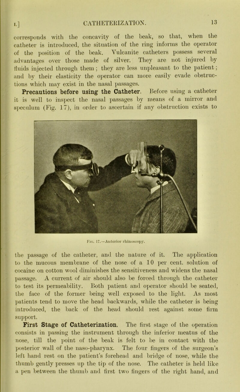 «•] corresponds with the concavity of the beak, so that, when the catheter is introduced, the situation of the ring informs the operator of the position of the beak. Vulcanite catheters possess several advantages over those made of silver. They are not injured by fluids injected through them ; they are less unpleasant to the patient; and by their elasticity the operator can more easily evade obstruc- tions which may exist in the nasal passages. Precautions before using the Catheter. Before using a catheter it is well to inspect the nasal passages by means of a mirror and speculum (Fig. 17), in order to ascertain if any obstruction exists to Fig. 17.—Anterior rhinoscopy. the passage of the catheter, and the nature of it. The application to the mucous membrane of the nose of a 10 per cent, solution of cocaine on cotton wool diminishes the sensitiveness and widens the nasal passage. A current of air should also be forced through the catheter to test its permeability. Both patient and operator should be seated, the face of the former being well exposed to the light. As most patients tend to move the head backwards, while the catheter is being introduced, the back of the head should rest against some firm support. First Stage of Catheterization. The first stage of the operation consists in passing the instrument through the inferior meatus of the nose, till the point of the beak is felt to be in contact with the posterior wall of the naso-pharynx. The four fingers of the surgeon’s left hand rest on the patient’s forehead and bridge of nose, while the thumb gently presses up the tip of the nose. The catheter is held like a pen between the thumb and first two fingers of the right hand, and