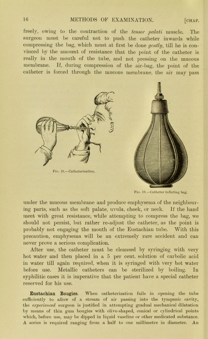 freely, owing to the contraction of the tensor palati muscle. The surgeon must be careful not to push the catheter inwards while compressing the bag, which must at first be done gently, till he is con- vinced by the amount of resistance that the point of the catheter is really in the mouth of the tube, and not pressing on the mucous membrane. If, during compression of the air-bag, the point of the catheter is forced through the mucous membrane, the air may pass Fig. 19.—Catheter inflating bag. under the mucous membrane and produce emphysema of the neighbour- ing parts, such as the soft palate, uvula, cheek, or neck. If the hand meet with great resistance, while attempting to compress the bag, we should not persist, but rather re-adjust the catheter, as the point is probably not engaging the mouth of the Eustachian tube. With this precaution, emphysema will be an extremely rare accident and can never prove a serious complication. After use, the catheter must be cleansed by syringing with very hot water and then placed in a 5 per cent, solution of carbolic acid in water till again required, when it is syringed with very hot water before use. Metallic catheters can be sterilized by boiling. In syphilitic cases it is imperative that the patient have a special catheter reserved for his use. Eustachian Bougies. When catheterization fails in opening the tube sufficiently to allow of a stream of air passing into the tympanic cavity, the experienced surgeon is justified in attempting gradual mechanical dilatation by means of thin gum bougies with olive-shaped, conical or cylindrical points which, before use, may be dipped in liquid vaseline or other medicated substance. A series is required ranging from a half to one millimetre in diameter. An