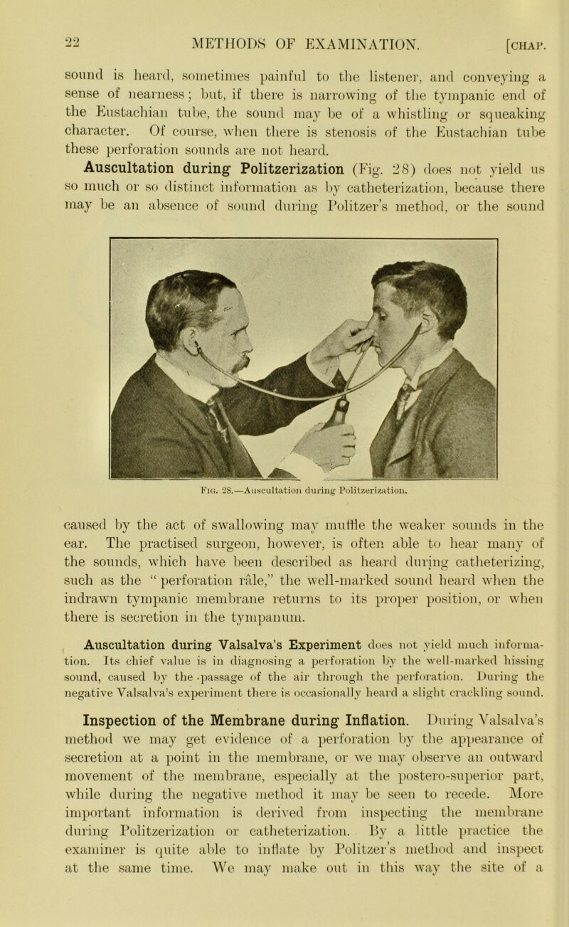 sound is heard, sometimes painful to the listener, and conveying a sense of nearness ; but, if there is narrowing of the tympanic end of the Eustachian tube, the sound may be of a whistling or squeaking character. Of course, when there is stenosis of the Eustachian tube these perforation sounds are not heard. Auscultation during Politzerization (Fig. 28) does not yield us so much or so distinct information as by catheterization, because there may be an absence of sound during Politzer’s method, or the sound Fig. 28.—Auscultation during Politzerization. caused by the act of swallowing may muffle the weaker sounds in the ear. The practised surgeon, however, is often able to hear many of the sounds, which have been described as heard during catheterizing. such as the “ perforation rale,” the well-marked sound heard when the indrawn tympanic membrane returns to its proper position, or when there is secretion in the tympanum. Auscultation during Valsalva’s Experiment does not yield much informa- tion. Its chief value is in diagnosing a perforation by the well-marked hissing sound, caused by the -passage of the air through the perforation. During the negative Valsalva’s experiment there is occasionally heard a slight crackling sound. Inspection of the Membrane during Inflation. During Valsalva’s method we may get evidence of a perforation by the appearance of secretion at a point in the membrane, or we may observe an outward movement of the membrane, especially at the postero-superior part, while during the negative method it may be seen to recede. More important information is derived from inspecting tbe membrane during Politzerization or catheterization. By a little practice the examiner is quite able to inflate by Politzer’s method and inspect at the same time. We may make out in this way the site of a