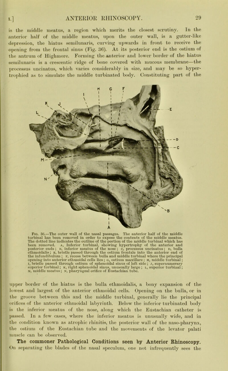 is the middle meatus, a region which merits the closest scrutiny. In the anterior half of the middle meatus, upon the outer wall, is a gutter-like depression, the hiatus semilunaris, curving upwards in front to receive the opening from the frontal sinus (Fig. 36). At its posterior end is the ostium of the antrum of Highmore. Forming the anterior and lower border of the hiatus semilunaris is a crescentic ridge of bone covered with mucous membrane—the processus uncinatus, which varies considerably in size, and may be so hyper- trophied as to simulate the middle turbinated body. Constituting part of the Fig. 36.—The outer wall of the nasal passages. The anterior half of the middle turbinal has been removed in order to expose the contents of the middle meatus. The dotted line indicates the outline of the portion of the middle turbinal which has been removed, a, Inferior turbinal, showing hypertrophy of the anterior and posterior ends ; b, inferior meatus of the nose ; c, processus uncinatus ; d, bulla ethmoidalis; e, bristle passed through the ostium frontale into the anterior end of the infundibulum ; f, recess between bulla and middle turbinal where the principal opening into anterior ethmoidal cells lies ; g, ostium maxillare ; h, middle turbinal; i, bristle passed through ostium of sphenoidal sinus of left side ; j, supernumerary superior turbinal; k, right sphenoidal sinus, unusually large ; l, superior turbinal ; m, middle meatus; n, pharyngeal orifice of Eustachian tube. upper border of the hiatus is the bulla ethmoidalis, a bony expansion of the lowest and largest of the anterior ethmoidal cells. Opening on the bulla, or in the groove between this and the middle turbinal, generally lie the principal orifices of the anterior ethmoidal labyrinth. Below the inferior turbinated body is the inferior meatus of the nose, along which the Eustachian catheter is passed. In a few cases, where the inferior meatus is unusually wide, and in the condition known as atrophic rhinitis, the posterior wall of the naso-pharynx, the ostium of the Eustachian tube and the movements of the levator palati muscle can be observed. The commoner Pathological Conditions seen by Anterior Rhinoscopy. On separating the blades of the nasal speculum, one not infrequently sees the