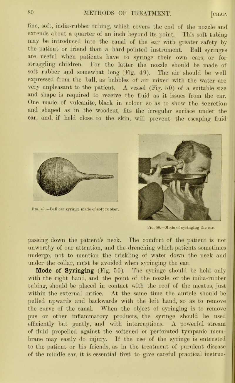 fine, soft, india-rubber tubing, which covers the end of the nozzle and extends about a quarter of an inch beyond its point. This soft tubing may be introduced into the canal of the ear with greater safety by the patient or friend than a hard-pointed instrument. Ball syringes are useful when patients have to syringe their own ears, or for struggling children. For the latter the nozzle should be made of soft rubber and somewhat long (Fig. 49). The air should be well expressed from the ball, as bubbles of air mixed with the water are very unpleasant to the patient. A vessel (Fig. 50) of a suitable size and shape is required to receive the fluid as it issues from the ear. One made of vulcanite, black in colour so as to show the secretion and shaped as in the woodcut, fits the irregular surface under the ear, and, if held close to the skin, will prevent the escaping fluid Fig. 50.—Mode of syringing the ear. passing down the patient’s neck. The comfort of the patient is not unworthy of our attention, and the drenching which patients sometimes undergo, not to mention the trickling of water down the neck and under the collar, must be avoided when syringing the ear. Mode of Syringing (Fig. 50). The syringe should be held only with the right hand, and the point of the nozzle, or the india-rubber tubing, should be placed in contact with the roof of the meatus, just within the external orifice. At the same time the auricle should be pulled upwards and backwards with the left hand, so as to remove the curve of the canal. When the object of syringing is to remove pus or other inflammatory products, the syringe should be used efficiently but gently, and with interruptions. A powerful stream of fluid propelled against the softened or perforated tympanic mem- brane may easily do injury. If the use of the syringe is entrusted to the patient or his friends, as in the treatment of purulent disease of the middle ear, it is essential first to give careful practical instruc-