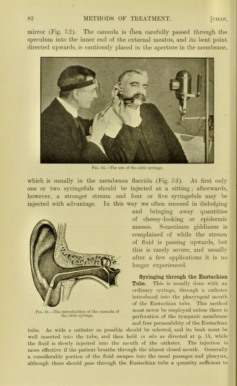 mirror (Fig. 52). The cannula is then carefully passed through the speculum into the inner end of the external meatus, and its bent point directed upwards, is cautiously placed in the aperture in the membrane. Fig. 52.—The use of the attic syringe. which is usually in the membrana flaccida (Fig. 53). At first only one or two syringefuls should be injected at a sitting ; afterwards, however, a stronger stream and four or five syringefuls may be injected with advantage. In this way we often succeed in dislodging and bringing away quantities of cheesy-looking or epidermic masses. Sometimes giddiness is complained of while the stream of fluid is passing upwards, but this is rarely severe, and usually after a few applications it is no longer experienced. Syringing through the Eustachian Tube. This is usually done with an ordinary syringe, through a catheter introduced into the pharyngeal mouth of the Eustachian tube. This method must never be employed unless there is perforation of the tympanic membrane and free permeability of the Eustachian tube. As wide a catheter as possible should be selected, and its beak must be well inserted into the tube, and then held in situ as directed at p. 15, while the fluid is Slowly injected into the mouth of the catheter. The injection is more effective if the patient breathe through the almost closed mouth. Generally a considerable portion of the fluid escapes into the nasal passages and pharynx, although there should pass through the Eustachian tube a quantity sufficient to Fig. 53.—The introduction of the cannula of the attic syringe.
