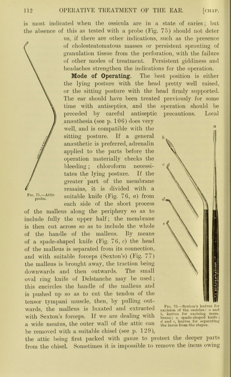 a Fig. 75.—Attic probe. is most indicated when the ossicula are in a state of caries; but the absence of this as tested with a probe (Fig. 75) should not deter us, if there are other indications, such as the presence of cholesteatomatous masses or persistent sprouting of granulation tissue from the perforation, with the failure of other modes of treatment. Persistent giddiness and headaches strengthen the indications for the operation. Mode of Operating. The best position is either the lying posture with the head pretty well raised, or the sitting posture with the head firmly supported. The ear should have been treated previously for some time with antiseptics, and the operation should be preceded by careful antiseptic precautions. Local anaesthesia (see p. 106) does very well, and is compatible with the sitting posture. If a general anaesthetic is preferred, adrenalin applied to the parts before the operation materially checks the bleeding; chloroform necessi- tates the lying posture. If the greater part of the membrane remains, it is divided with a suitable knife (Fig. 7 6, a) from each side of the short process of the malleus along the periphery so as to include fully the upper half; the membrane is then cut across so as to include the whole of the handle of the malleus. By means of a spade-shaped knife (Fig. 7 6, c) the head of the malleus is separated from its connection, and with suitable forceps (Sexton’s) (Fig. 77) the malleus is brought away, the traction being downwards and then outwards. The small oval ring knife of Delstanche may be used; this encircles the handle of the malleus and is pushed up so as to cut the tendon of the tensor tympani muscle, then, by pulling out- wards, the malleus is luxated and extracted with Sexton’s forceps. If we are dealing with a wide meatus, the outer wall of the attic can be removed with a suitable chisel (see p. 129), the attic being first packed with gauze to protect the deeper parts from the chisel. Sometimes it is impossible to remove the incus owing Fig. Tib—Sexton’s knives for excision of the ossicles : a and b, knives for excising mem- brane ; c, spade-shaped knife ; d and e, knives for separating the incus from the stapes.