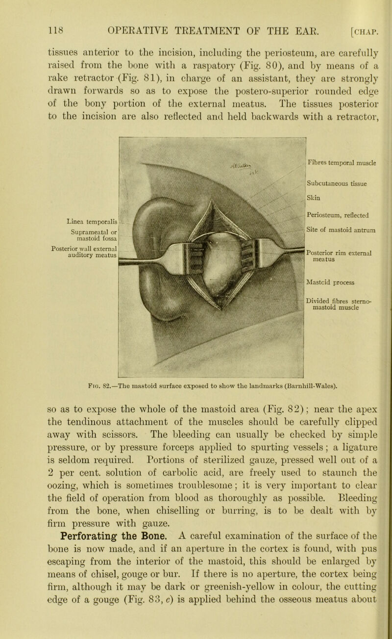 tissues anterior to the incision, including the periosteum, are carefully raised from the bone with a raspatory (Fig. 80), and by means of a rake retractor (Fig. 81), in charge of an assistant, they are strongly drawn forwards so as to expose the postero-superior rounded edge of the bony portion of the external meatus. The tissues posterior to the incision are also reflected and held backwards with a retractor, Linea temporalis Suprameatal or mastoid fossa Posterior wall external auditory meatus —' ;:;;n JsQjXfo* Fibres temporal muscle Subcutaneous tissue Skin I Periosteum, reflected Site of mastoid antrum Posterior rim external meatus Mastoid process Divided fibres stemo mastoid muscle Fig. S2.—The mastoid surface exposed to show the landmarks (Barnhill-Wales). so as to expose the whole of the mastoid area (Fig. 82); near the apex the tendinous attachment of the muscles should be carefully clipped away with scissors. The bleeding can usually be checked by simple pressure, or by pressure forceps applied to spurting vessels; a ligature is seldom required. Portions of sterilized gauze, pressed well out of a 2 per cent, solution of carbolic acid, are freely used to staunch the oozing, which is sometimes troublesome; it is very important to clear the field of operation from blood as thoroughly as possible. Bleeding from the bone, when chiselling or burring, is to be dealt with by firm pressure with gauze. Perforating the Bone. A careful examination of the surface of the bone is now made, and if an aperture in the cortex is found, with pus escaping from the interior of the mastoid, this should be enlarged by means of chisel, gouge or bur. If there is no aperture, the cortex being firm, although it may be dark or greenish-yellow in colour, the cutting edge of a gouge (Fig. 83, c) is applied behind the osseous meatus about