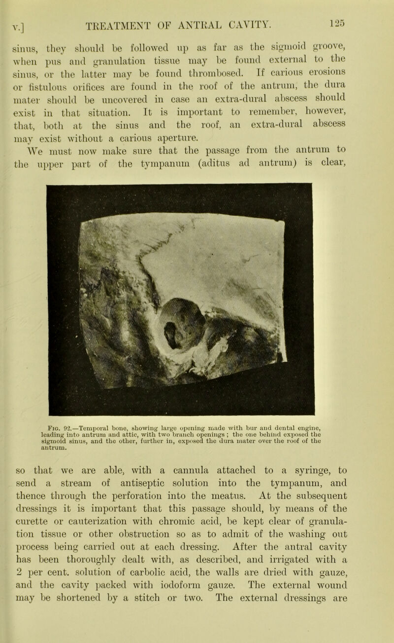 or, sinus, they should be followed up as far as the sigmoid groove, when pus and granulation tissue may be found external to the sinus, or the latter may be found thrombosed. If carious erosions or fistulous orifices are found in the roof of the antrum, the dura mater should be uncovered in case an extra-dural abscess should exist in that situation. It is important to remember, however, that, both at the sinus and the roof, an extra-dural abscess may exist without a carious aperture. We must now make sure that the passage from the antrum to the upper part of the tympanum (aditus ad antrum) is clear, Fig. 92.—Temporal bone, showing large opening made with bur and dental engine, leading into antrum and attic, with two branch openings ; the one behind exposed the sigmoid sinus, and the other, further in, exposed the dura mater over the roof of the antrum. so that we are able, with a cannula attached to a syringe, to send a stream of antiseptic solution into the tympanum, and thence through the perforation into the meatus. At the subsequent dressings it is important that this passage should, by means of the curette or cauterization with chromic acid, be kept clear of granula- tion tissue or other obstruction so as to admit of the washing out process being carried out at each dressing. After the antral cavity has been thoroughly dealt with, as described, and irrigated with a 2 per cent, solution of carbolic acid, the walls are dried with gauze, and the cavity packed with iodoform gauze. The external wound may be shortened by a stitch or two. The external dressings are