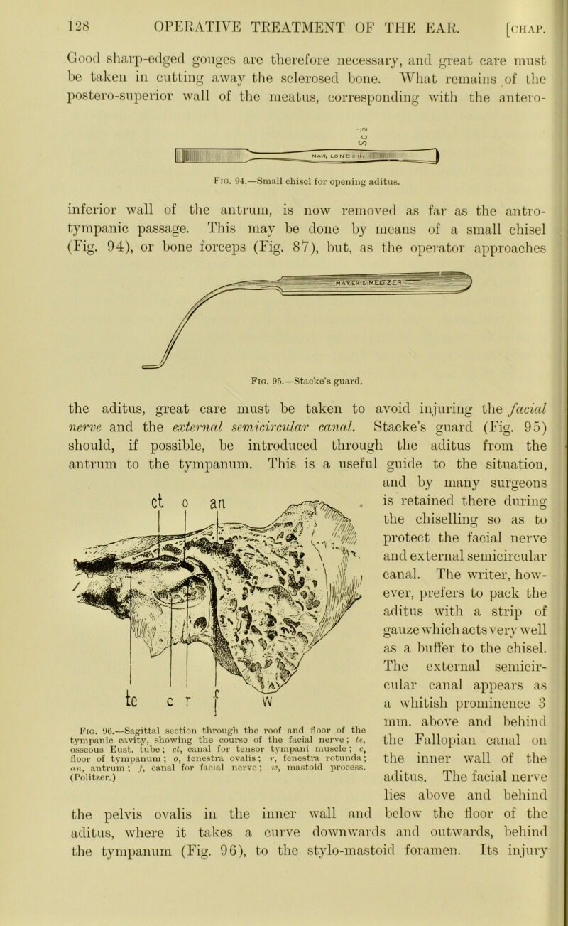 Good sharp-edged gouges are therefore necessary, and great care must be taken in cutting away the sclerosed bone. What remains of the postero-superior wall of the meatus, corresponding with the antero- -|r\j o oo ^ Fig. 94.—Small chisel for opening aditus. inferior wall of the antrum, is now removed as far as the antro- tympanic passage. This may be done by means of a small chisel (Fig. 94), or bone forceps (Fig. 87), but, as the operator approaches the aditus, great care must be taken to avoid injuring the facial nerve and the external semicircular canal. Stacke’s guard (Fig. 95) should, if possible, be introduced through the aditus from the antrum to the tympanum. This is a useful guide to the situation, and by many surgeons is retained there during the chiselling so as to O protect the facial nerve and external semicircular canal. The writer, how- ever, prefers to pack the aditus with a strip of gauze which acts very well as a buffer to the chisel. The external semicir- cular canal appears as a whitish prominence 3 mm. above and behind the Fallopian canal on the inner wall of the aditus. The facial nerve lies above and behind the pelvis ovalis in the inner wall and below the door of the aditus, where it takes a curve downwards and outwards, behind the tympanum (Fig. 96), to the stylo-mastoid foramen. Its injury Fig. 96.—Sagittal section through the roof and floor of the tympanic cavity, showing the course of the facial nerve ; te, osseous Bust, tube; ct, canal for tensor tympani muscle ; c, floor of tympanum ; o, fenestra ovalis; r, fenestra rotunda; an, antrum ; /, canal for facial nerve; 10, mastoid process. (Politzer.)