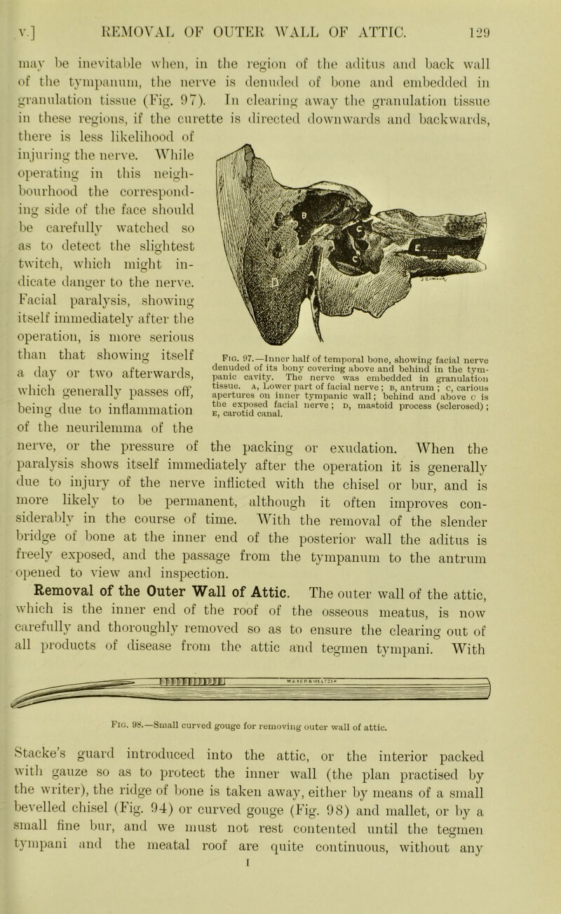 may be inevitable when, in the region of the aditus and back wall of the tympanum, the nerve is denuded of bone and embedded in granulation tissue (Fig. 97). In clearing away the granulation tissue in these regions, if the curette is directed downwards and backwards, there is less likelihood of injuring the nerve. While operating in this neigh- bourhood the correspond- ing side of the face should be carefully watched so as to detect the slightest twitch, which might in- dicate danger to the nerve. Facial paralysis, showing itself immediately after the operation, is more serious than that showing itself a day or two afterwards, which generally passes off, being due to inflammation of the neurilemma of the nerve, or the pressure of the packing or exudation. When the paralysis shows itself immediately after the operation it is generally due to injury of the nerve inflicted with the chisel or bur, and is more likely to be permanent, although it often improves con- siderably in the course of time. With the removal of the slender bridge of bone at the inner end of the posterior wall the aditus is freely exposed, and the passage from the tympanum to the antrum opened to view and inspection. Removal of the Outer Wall of Attic. The outer wall of the attic, which is the inner end of the roof of the osseous meatus, is now carefully and thoroughly removed so as to ensure the clearing out of all products of disease from the attic and tegmen tympani. With Fig. 97.—Inner half of temporal bone, showing facial nerve denuded of its bony covering above and behind in the tym- panic cavity. The nerve was embedded in granulation tissue, a, Lower part of facial nerve ; b, antrum ; c, carious apertures on inner tympanic wall; behind and above c is the exposed facial nerve ; d, mastoid process (sclerosed) ; e, carotid canal. Fig. 98.—Small curved gouge for removing outer wall of attic. Stacke s guard introduced into the attic, or the interior packed with gauze so as to protect the inner wall (the plan practised by the writer), the ridge of bone is taken away, either by means of a small be veiled chisel (Fig. 94) or curved gouge (Fig. 98) and mallet, or by a small fine bur, and we must not rest contented until the tegmen tympani and the meatal roof are cpiite continuous, without any i