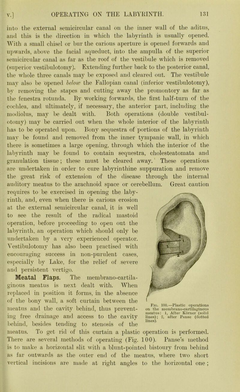 into the external semicircular canal on the inner wall of the aditus, and this is the direction in which the labyrinth is usually opened. With a small chisel or bur the carious aperture is opened forwards and upwards, above the facial aqueduct, into the ampulla of the superior semicircular canal as far as the roof of the vestibule which is removed (superior vestibulotomy). Extending further back to the posterior canal, the whole three canals may be exposed and cleared out. The vestibule may also be opened below the Fallopian canal (inferior vestibulotomy), by removing the stapes and cutting away the promontory as far as the fenestra rotunda. By working forwards, the first half-turn of the cochlea, and ultimately, if necessary, the anterior part, including the modiolus, may be dealt with. Both operations (double vestibul- otomy) may be carried out when the whole interior of the labyrinth has to be operated upon. Bony sequestra of portions of the labyrinth may be found and removed from the inner tympanic wall, in which there is sometimes a large opening, through which the interior of the labyrinth may be found to contain sequestra, cholesteatomata and granulation tissue; these must be cleared away.1 These operations are undertaken in order to cure labyrinthine suppuration and remove the great risk of extension of the disease through the internal o o auditory meatus to the arachnoid space or cerebellum. Great caution requires to be exercised in opening the laby- rinth, and, even when there is carious erosion at the external semicircular canal, it is well to see the result of the radical mastoid operation, before proceeding to open out the labyrinth, an operation which should only be undertaken by a very experienced operator. Vestibulotomy has also been practised with encouraging success in non-purulent cases, especially by Lake, for the relief of severe and persistent vertigo. Meatal Flaps. The membrano-cartila- ginous meatus is next dealt with. When replaced in position it forms, in the absence of the bony wall, a soft curtain between the meatus and the cavity behind, thus prevent- ing free drainage and access to the cavity behind, besides tending to stenosis of the meatus. To get rid of this curtain a plastic operation is performed. There are several methods of operating (Fig. 100). Panse’s method is to make a horizontal slit with a blunt-pointed bistoury from behind as far outwards as the outer end of the meatus, where two short vertical incisions are made at right angles to the horizontal one ; Fig. 100.—Plastic operations on the membrano-cartilaginous meatus: 1, After Korner (solid lines); 2, after Pause (dotted lines).