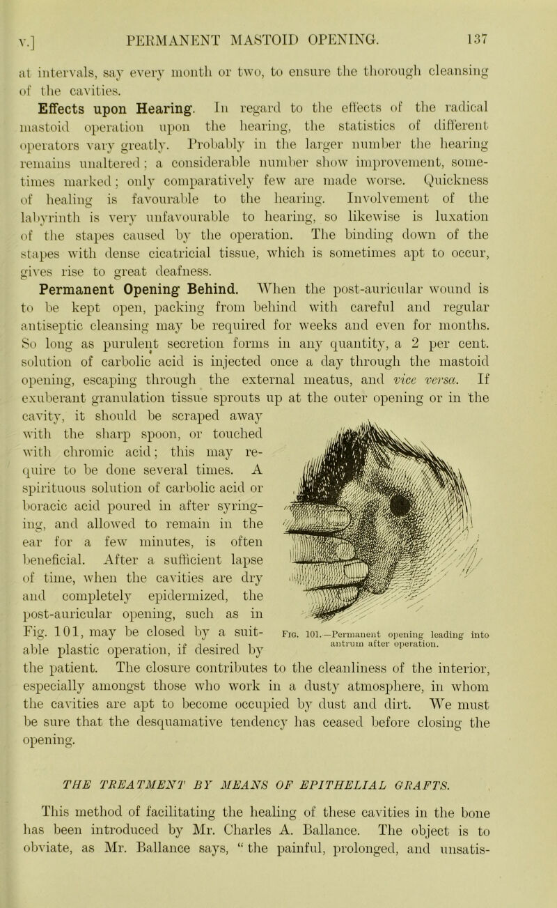 at intervals, say every month or two, to ensure the thorough cleansing of the cavities. Effects upon Hearing. In regard to the effects of the radical mastoid operation upon the hearing, the statistics of different- operators vary greatly. Probably in the larger number the hearing remains unaltered; a considerable number show improvement, some- times marked; only comparatively few are made worse. Quickness of healing is favourable to the hearing. Involvement of the labyrinth is very unfavourable to hearing, so likewise is luxation of the stapes caused by the operation. The binding down of the stapes with dense cicatricial tissue, which is sometimes apt to occur, gives rise to great deafness. Permanent Opening Behind. When the post-auricular wound is to be kept open, packing from behind with careful and regular antiseptic cleansing may be required for weeks and even for months. So long as purulent secretion forms in any quantity, a 2 per cent, solution of carbolic acid is injected once a day through the mastoid opening, escaping through the external meatus, and vice versa. If exuberant granulation tissue sprouts up at the outer opening or in the cavity, it should be scraped away with the sharp spoon, or touched with chromic acid; this may re- quire to be done several times. A spirituous solution of carbolic acid or boracic acid poured in after syring- ing, and allowed to remain in the ear for a fewT minutes, is often beneficial. After a sufficient lapse of time, when the cavities are dry and completely epidermized, the post-auricular opening, such as in Fig. 101, may be closed by a suit- able plastic operation, if desired by the patient. The closure contributes to the cleanliness of the interior, especially amongst those who work in a dusty atmosphere, in whom the cavities are apt to become occupied by dust and dirt. We must be sure that the desquamative tendency has ceased before closing the opening. Fig. 101.—Permanent opening leading into antrum after operation. THE TREATMENT BY MEANS OF EPITHELIAL GRAFTS. This method of facilitating the healing of these cavities in the bone has been introduced by Mr. Charles A. Ballance. The object is to obviate, as Mr. Ballance says, “ the painful, prolonged, and unsatis-