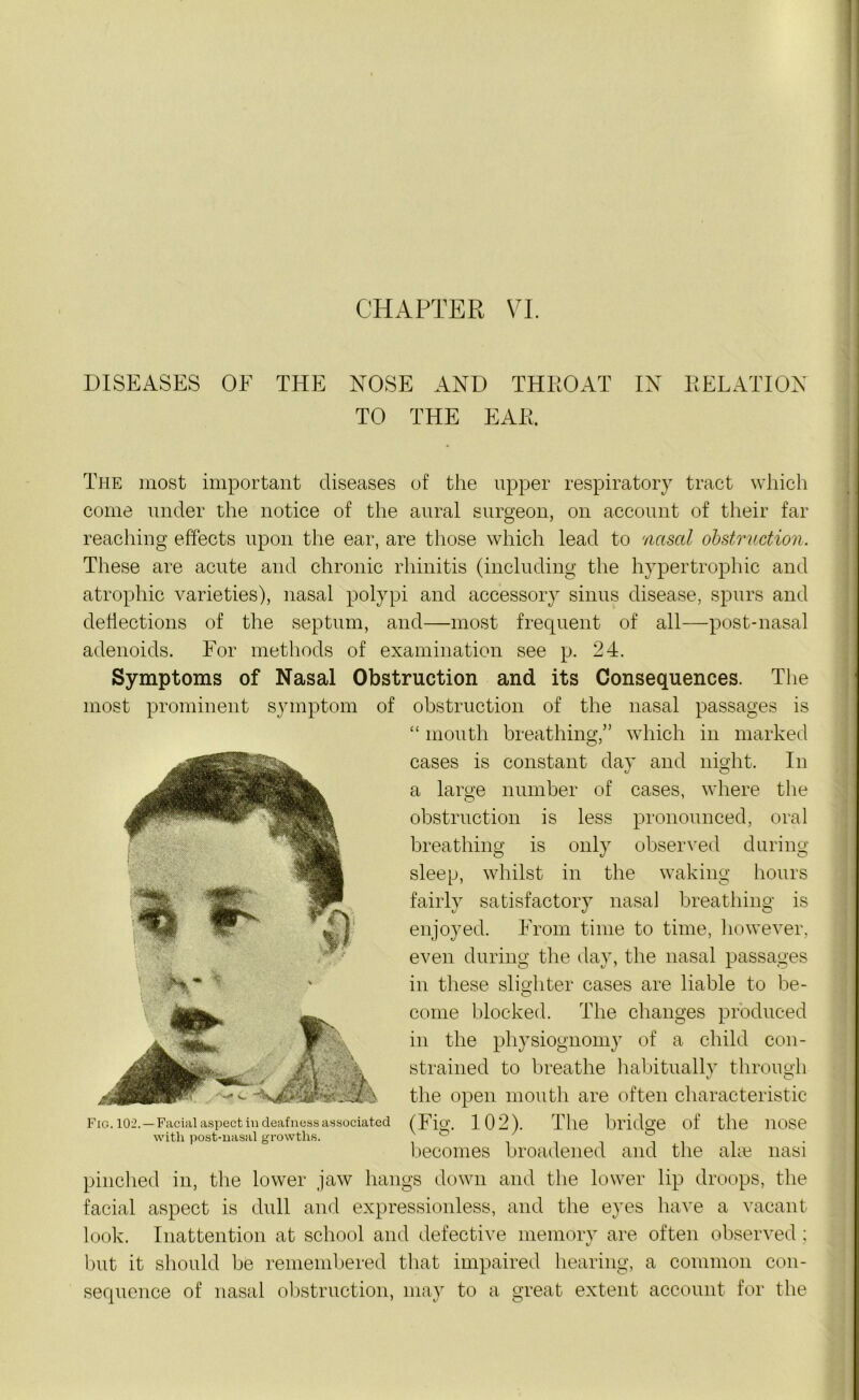 CHAPTER VI. DISEASES OF THE NOSE AND THROAT IN RELATION TO THE EAR. The most important diseases of the upper respiratory tract which come under the notice of the aural surgeon, on account of their far reaching effects upon the ear, are those which lead to nasal obstruction. These are acute and chronic rhinitis (including the hypertrophic and atrophic varieties), nasal polypi and accessory sinus disease, spurs and deflections of the septum, and—most frequent of all—post-nasal adenoids. For methods of examination see p. 24. Symptoms of Nasal Obstruction and its Consequences. The most prominent symptom of obstruction of the nasal passages is “ mouth breathing,” which in marked cases is constant day and night. In a large number of cases, where the obstruction is less pronounced, oral breathing is only observed during sleep, whilst in the waking hours fairly satisfactory nasal breathing is enjoyed. From time to time, however, even during the day, the nasal passages in these slighter cases are liable to be- come blocked. The changes produced in the physiognomy of a child con- strained to breathe habitually through the open mouth are often characteristic (Fig. 102). The bridge of the nose becomes broadened and the alte nasi pinched in, the lower jaw hangs down and the lower lip droops, the facial aspect is dull and expressionless, and the eyes have a vacant look. Inattention at school and defective memory are often observed; but it should be remembered that impaired hearing, a common con- sequence of nasal obstruction, may to a great extent account for the Fig. 102. — Facial aspect in deafness associated with post-uasal growths.