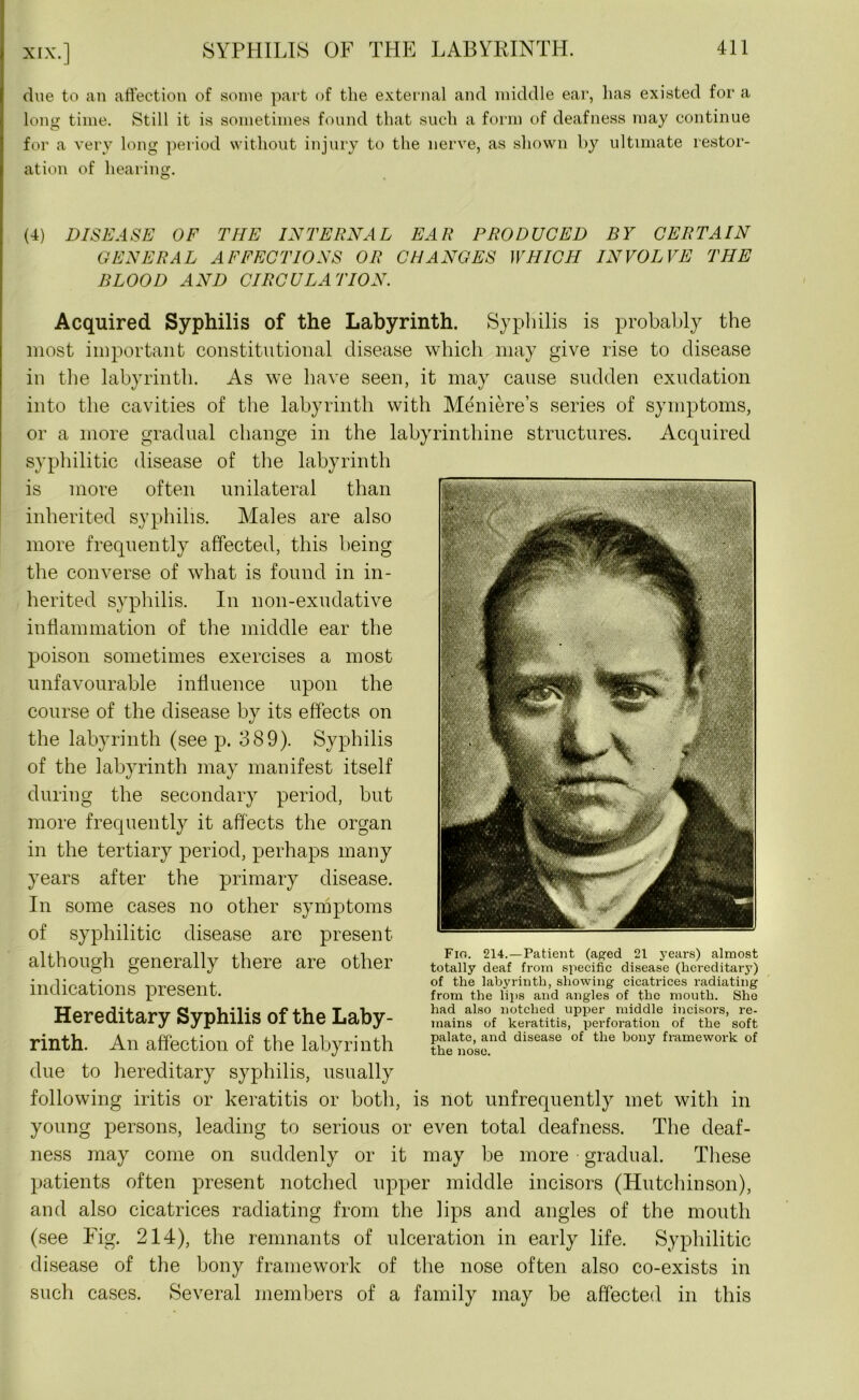 due to an affection of some part of the external and middle ear, has existed for a long time. Still it is sometimes found that such a form of deafness may continue for a very long period without injury to the nerve, as shown by ultimate restor- ation of hearing. (4) DISEASE OF THE INTERNAL EAR PRODUCED BY CERTAIN GENERAL AFFECTIONS OR CHANGES WHICH INVOLVE THE BLOOD AND CIRCULATION. Acquired Syphilis of the Labyrinth. Syphilis is probably the most important constitutional disease which may give rise to disease in the labyrinth. As we have seen, it may cause sudden exudation into the cavities of the labyrinth with Meniere’s series of symptoms, or a more gradual change in the labyrinthine structures. Acquired syphilitic disease of the labyrinth is more often unilateral than inherited syphilis. Males are also more frequently affected, this being the converse of what is found in in- herited syphilis. In non-exudative inflammation of the middle ear the poison sometimes exercises a most unfavourable influence upon the course of the disease by its effects on the labyrinth (seep. 389). Syphilis of the labyrinth may manifest itself during the secondary period, but more frequently it affects the organ in the tertiary period, perhaps many years after the primary disease. In some cases no other symptoms of syphilitic disease are present although generally there are other indications present. Hereditary Syphilis of the Laby- rinth. An affection of the labyrinth due to hereditary syphilis, usually following iritis or keratitis or both, is not unfrequently met with in young persons, leading to serious or even total deafness. The deaf- ness may come on suddenly or it may be more gradual. These patients often present notched upper middle incisors (Hutchinson), and also cicatrices radiating from the lips and angles of the mouth (see Fig. 214), the remnants of ulceration in early life. Syphilitic disease of the bony framework of the nose often also co-exists in such cases. Several members of a family may be affected in this Fig. 214.—Patient (aged 21 years) almost totally deaf from specific disease (hereditary) of the labyrinth, showing cicatrices radiating from the lips and angles of the mouth. She had also notched upper middle incisors, re- mains of keratitis, perforation of the soft palate, and disease of the bony framework of the nose.
