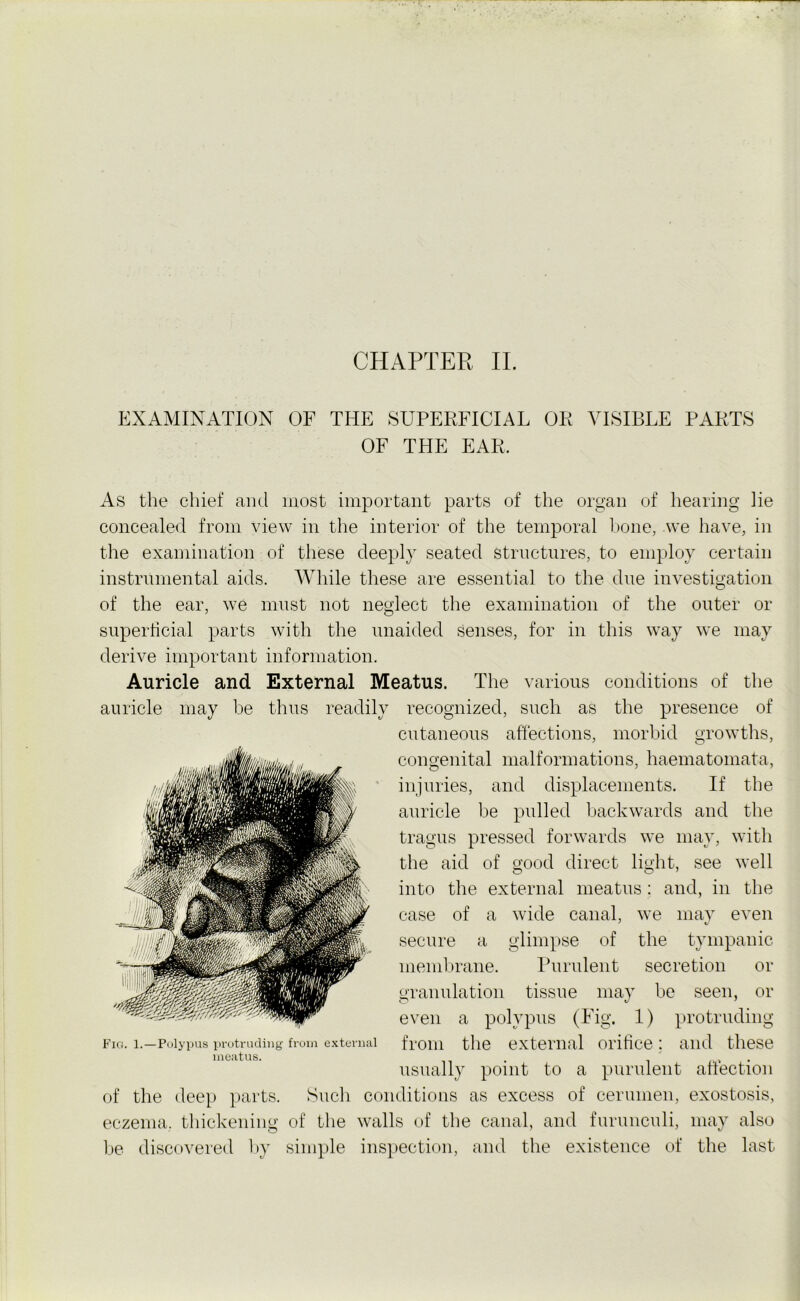 EXAMINATION OF THE SUPERFICIAL OR VISIBLE PARTS OF THE EAR, As the chief and most important parts of the organ of hearing lie concealed from view in the interior of the temporal bone, we have, in the examination of these deeply seated structures, to employ certain instrumental aids. While these are essential to the due investigation of the ear, we must not neglect the examination of the outer or superficial parts with the unaided senses, for in this way we may derive important information. Auricle and External Meatus. The various conditions of the auricle may be thus readily recognized, such as the presence of cutaneous affections, morbid growths, congenital malformations, haematomata, injuries, and displacements. If the auricle be pulled backwards and the tragus pressed forwards we may, with the aid of good direct light, see well into the external meatus : and, in the case of a wide canal, we may even secure a glimpse of the tympanic membrane. Purulent secretion or granulation tissue may be seen, el- even a polypus (Fig. 1) protruding from the external orifice: and these usually point to a purulent affection of the deep parts. Such conditions as excess of cerumen, exostosis, eczema, thickening of the walls of the canal, and furunculi, may also be discovered by simple inspection, and the existence of the last Fig. 1. — Polypus protruding from external meatus.