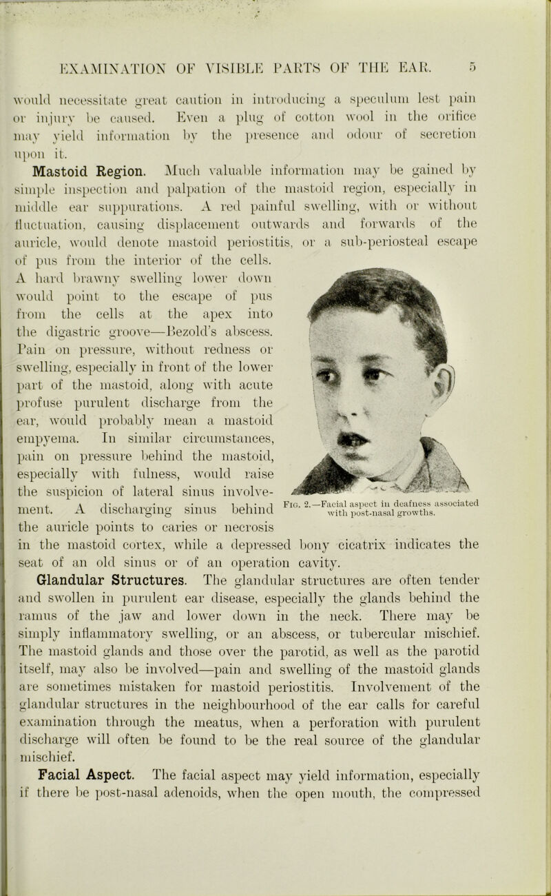 would necessitate great caution in introducing a speculum lest pain or injury be caused. Even a plug of cotton wool in the orifice may yield information by the presence and odour of secretion upon it. Mastoid Region. Much valuable information may be gained by simple inspection and palpation of the mastoid region, especially in middle ear suppurations. A red painful swelling, with or without fluctuation, causing displacement outwards and forwards of the auricle, would denote mastoid periostitis, or a sub-periosteal escape of pus from the interior of the cells. A hard brawny swelling lower down would point to the escape of pus from the cells at the apex into the digastric groove—Bezold’s abscess. Pain on pressure, without redness or swelling, especially in front of the lower part of the mastoid, along with acute profuse purulent discharge from the ear, would probably mean a mastoid empyema. In similar circumstances, pain on pressure behind the mastoid, especially with fulness, would raise the suspicion of lateral sinus involve- ment. A discharging sinus behind O O Fig. 2.—Facial aspect in deafness associated with post-nasal growths. the auricle points to caries or necrosis in the mastoid cortex, while a depressed bony cicatrix indicates the seat of an old sinus or of an operation cavity. Glandular Structures. The glandular structures are often tender and swollen in purulent ear disease, especially the glands behind the ramus of the jaw and lower down in the neck. There may be simply inflammatory swelling, or an abscess, or tubercular mischief. The mastoid glands and those over the parotid, as well as the parotid itself, may also be involved—pain and swelling of the mastoid glands are sometimes mistaken for mastoid periostitis. Involvement of the glandular structures in the neighbourhood of the ear calls for careful examination through the meatus, when a perforation with purulent discharge will often be found to be the real source of the glandular mischief. Facial Aspect. The facial aspect may yield information, especially if there be post-nasal adenoids, when the open mouth, the compressed