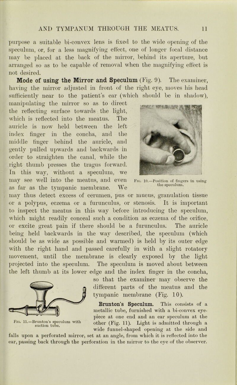 Fro. 10.—Position of fingers in using the speculum. purpose a suitable bi-con vex lens is fixed to the wide opening of the speculum, or, for a less magnifying effect, one of longer focal distance may be placed at the back of the mirror, behind its aperture, but arranged so as to be capable of removal when the magnifying effect is not desired. Mode of using the Mirror and Speculum (Fig. 9). The examiner, having the mirror adjusted in front of the right eye, moves his head sufficiently near to the patient's ear (which should be in shadow), manipulating the mirror so as to direct the reflecting surface towards the light, which is reflected into the meatus. The auricle is now held between the left index linger in the concha, and the middle finger behind the auricle, and gently pulled upwards and backwards in order to straighten the canal, while the right thumb presses the tragus forward. In this way, without a speculum, we may see well into the meatus, and even as far as the tympanic membrane. We may thus detect excess of cerumen, pus or mucus, granulation tissue or a polypus, eczema or a furunculus, or stenosis. It is important to inspect the meatus in this way before introducing the speculum, which might readily conceal such a condition as eczema of the orifice, or excite great pain if there should be a furunculus. The auricle being held backwards in the way described, the speculum (which should be as wide as possible and warmed) is held by its outer edge with the right hand and passed carefully in with a slight rotatory movement, until the membrane is clearly exposed by the light projected into the speculum. The speculum is moved about between the left thumb at its lower edge and the index finger in the concha, so that the examiner may observe the different parts of the meatus and the tympanic membrane (Fig. 10). Brunton’s Speculum. This consists of a metallic tube, furnished with a bi-con vex eye- piece at one end and an ear speculum at the other (Fig. 11). Light is admitted through a wide funnel-shaped opening at the side and falls upon a perforated mirror, set at an angle, from which it is reflected into the ear, passing back through the perforation in the mirror to the eye of the observer. Fig. 11.—Brunton’s speculum with suction tube.