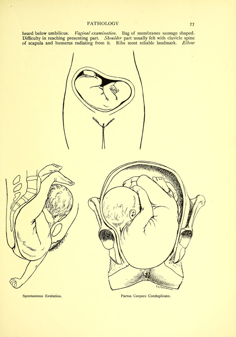 77 heard below umbilicus. Vaginal examination. Bag of membranes sausage shaped. Difficulty in reaching presenting part. Shoulder part usually felt with clavicle spine of scapula and humerus radiating from it. Ribs most reliable landmark. Elbow