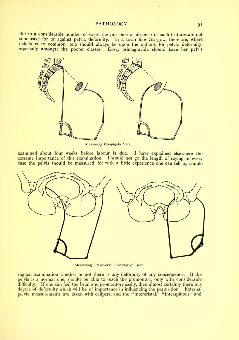 9i But in a considerable number of cases the presence or absence of such features are not conclusive for or against pelvic deformity. In a town like Glasgow, therefore, where rickets is so common, one should always be upon the outlook for pelvic deformity, especially amongst the poorer classes. Every primagravida should have her pelvis Measuring Conjugata Vera. examined about four weeks before labour is due. I have explained elsewhere the extreme importance of this examination. I would not go the length of saying in every case the pelvis should be measured, for with a little experience one can tell by simple Measuring Transverse Diameter of Brim. vaginal examination whether or not there is any deformity of any consequence. If the pelvis is a normal one, should be able to reach the promontory only with considerable difficulty. If one can feel the brim and promontory easily, then almost certainly there is a degree of deformity which will be of importance in influencing the parturition. External pelvic measurements are taken with calipers, and the “ intercristal,” “ interspinous ” and