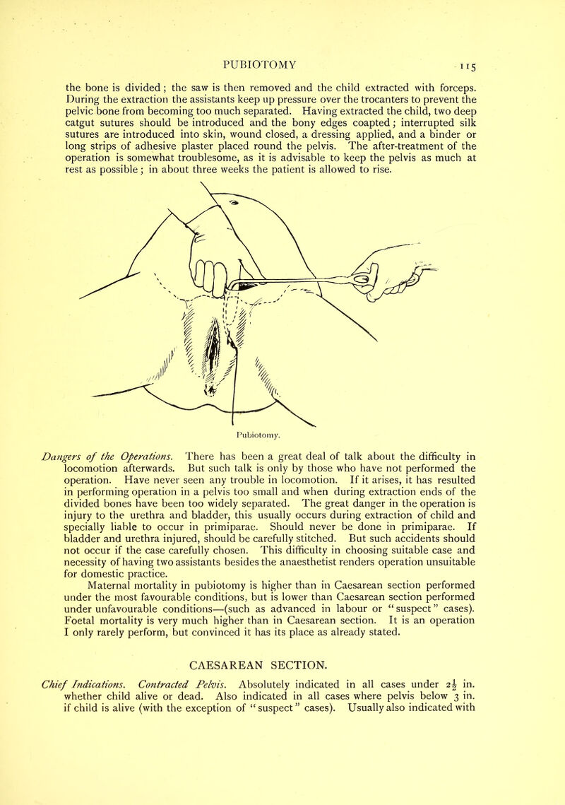 PUBIOTOMY ”5 the bone is divided; the saw is then removed and the child extracted with forceps. During the extraction the assistants keep up pressure over the trocanters to prevent the pelvic bone from becoming too much separated. Having extracted the child, two deep catgut sutures should be introduced and the bony edges coapted; interrupted silk sutures are introduced into skin, wound closed, a dressing applied, and a binder or long strips of adhesive plaster placed round the pelvis. The after-treatment of the operation is somewhat troublesome, as it is advisable to keep the pelvis as much at rest as possible; in about three weeks the patient is allowed to rise. Dangers of the Operations. There has been a great deal of talk about the difficulty in locomotion afterwards. But such talk is only by those who have not performed the operation. Have never seen any trouble in locomotion. If it arises, it has resulted in performing operation in a pelvis too small and when during extraction ends of the divided bones have been too widely separated. The great danger in the operation is injury to the urethra and bladder, this usually occurs during extraction of child and specially liable to occur in primiparae. Should never be done in primiparae. If bladder and urethra injured, should be carefully stitched. But such accidents should not occur if the case carefully chosen. This difficulty in choosing suitable case and necessity of having two assistants besides the anaesthetist renders operation unsuitable for domestic practice. Maternal mortality in pubiotomy is higher than in Caesarean section performed under the most favourable conditions, but is lower than Caesarean section performed under unfavourable conditions—(such as advanced in labour or “ suspect ” cases). Foetal mortality is very much higher than in Caesarean section. It is an operation I only rarely perform, but convinced it has its place as already stated. CAESAREAN SECTION. Chief Indications. Contracted Pelvis. Absolutely indicated in all cases under 2£ in. whether child alive or dead. Also indicated in all cases where pelvis below 3 in. if child is alive (with the exception of “suspect” cases). Usually also indicated with