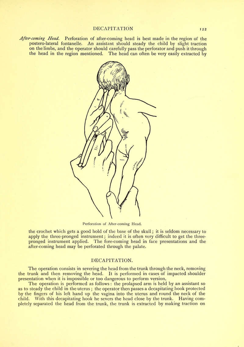 DECAPITATION 22 After-coming Head. Perforation of after-coming head is best made in the region of the postero-lateral fontanelle. An assistant should steady the child by slight traction on the limbs, and the operator should carefully pass the perforator and push it through the head in the region mentioned. The head can often be very easily extracted by Perforation of After-coming Head. the crochet which gets a good hold of the base of the skull; it is seldom necessary to apply the three-pronged instrument; indeed it is often very difficult to get the three- pronged instrument applied. The fore-coming head in face presentations and the after-coming head may be perforated through the palate. DECAPITATION. The operation consists in severing the head from the trunk through the neck, removing the trunk and then removing the head. It is performed in cases of impacted shoulder presentation when it is impossible or too dangerous to perform version. The operation is performed as follows: the prolapsed arm is held by an assistant so as to steady the child in the uterus; the operator then passes a decapitating hook protected by the fingers of his left hand up the vagina into the uterus and round the neck of the child. With this decapitating hook he severs the head close by the trunk. Having com- pletely separated the head from the trunk, the trunk is extracted by making traction on