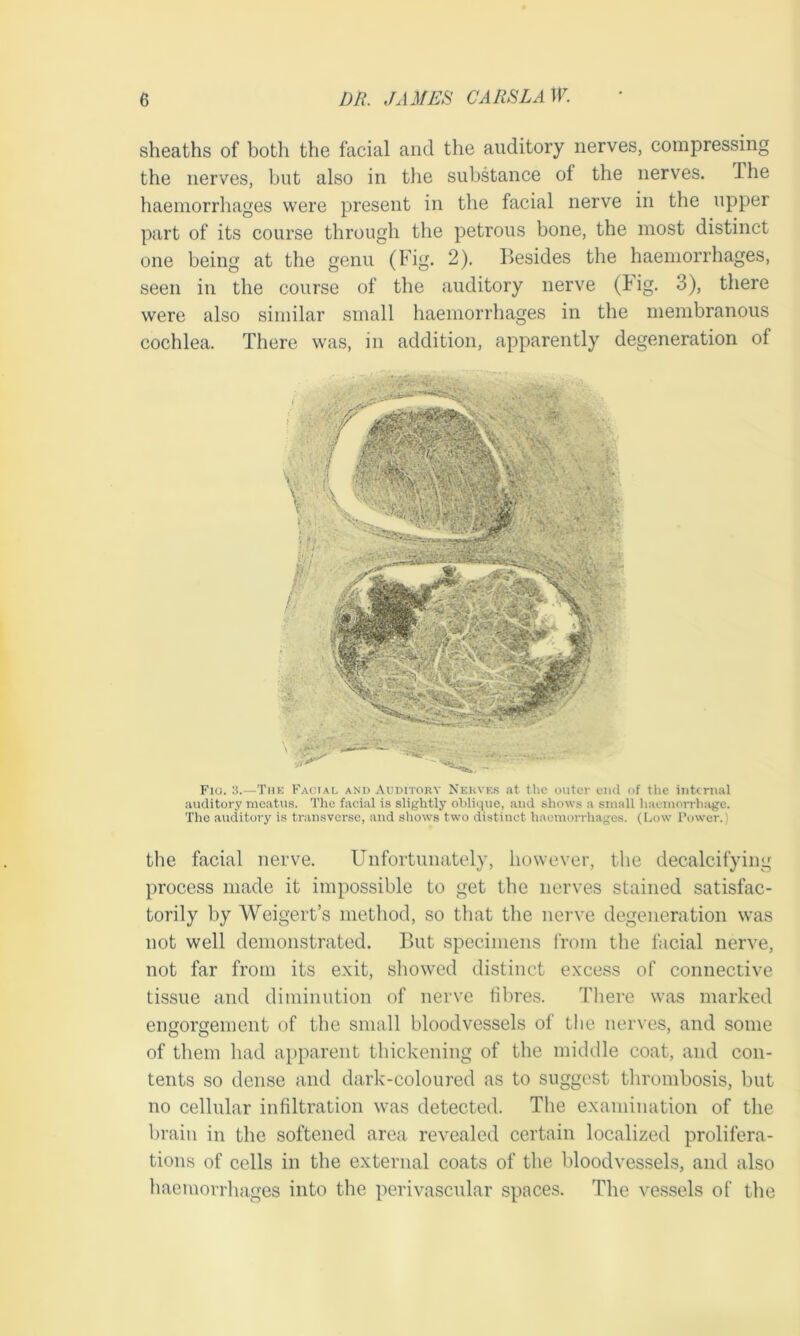 sheaths of both the facial and the auditory nerves, compressing the nerves, but also in the substance ol the nerves. I he haemorrhages were present in the facial nerve in the upper part of its course through the petrous bone, the most distinct one being at the genu (Fig. 2). Besides the haemorrhages, seen in the course of the auditory nerve (tig. 3), there were also similar small haemorrhages in the membranous cochlea. There was, in addition, apparently degeneration of Fiu. 3.—Tin-: Facial and Auditory Nerves at the outer end of the internal auditory meatus. The facial is slightly oblique, and shows a small haemorrhage. The auditory is transverse, and shows two distinct haemorrhages. (Low Power.) the facial nerve. Unfortunately, however, the decalcifying process made it impossible to get the nerves stained satisfac- torily by Weigert’s method, so that the nerve degeneration was not well demonstrated. But specimens from the facial nerve, not far from its exit, showed distinct excess of connective tissue and diminution of nerve fibres. There was marked engorgement of the small bloodvessels of the nerves, and some of them had apparent thickening of the middle coat, and con- tents so dense and dark-coloured as to suggest thrombosis, but no cellular infiltration was detected. The examination of the brain in the softened area revealed certain localized prolifera- tions of cells in the external coats of the bloodvessels, and also haemorrhages into the perivascular spaces. The vessels of the