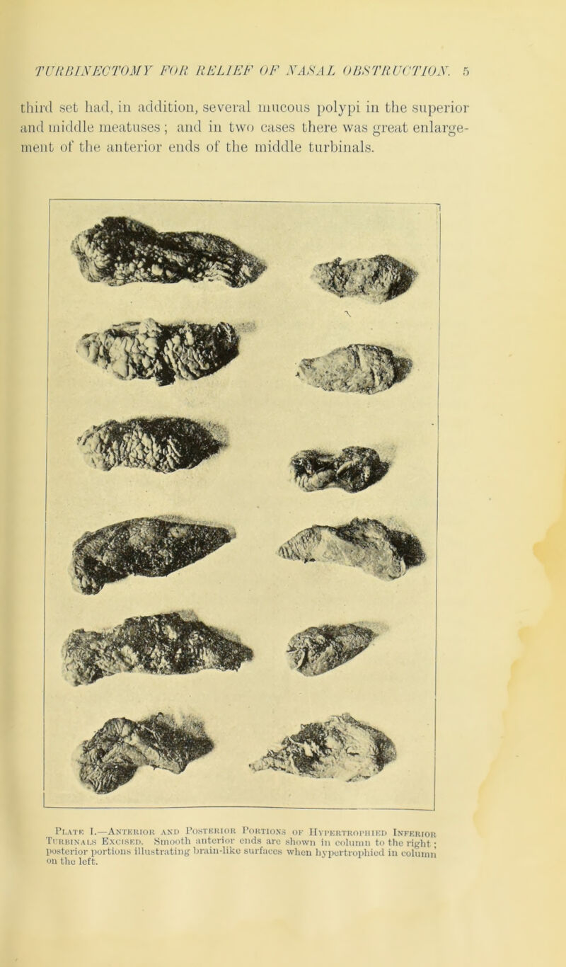 and middle meatuses ; and in two cases there was great enlarge- ment of the anterior ends of the middle turbinals. Plate I.—Anterioii and Posterior Portions ok Hypertrophied Inferior Turbinals Excised. Smooth anterior ends are shown in column to the right; posterior portions illustrating brain-like surfaces when hypertrophied in column on the left.