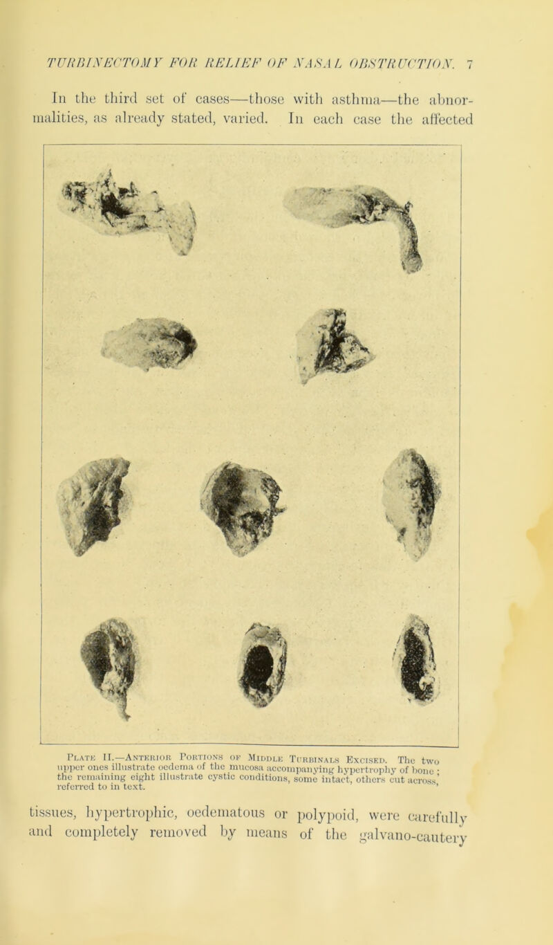 In the third set of cases—those vvitli asthma—the abnor- malities, as already stated, varied. In each case the affected Plate II.—Anterior Portions of Middle Tcrhinalh Excised. The two upper ones illustrate oedema of the mucosa accompanying hypertrophy of bone • the remaining eight illustrate cystic conditions, some intact, others cut across’ referred to in text. tissues, hypertrophic, oedematous or polypoid, were carefully and completely removed by means of the galvano-cautery