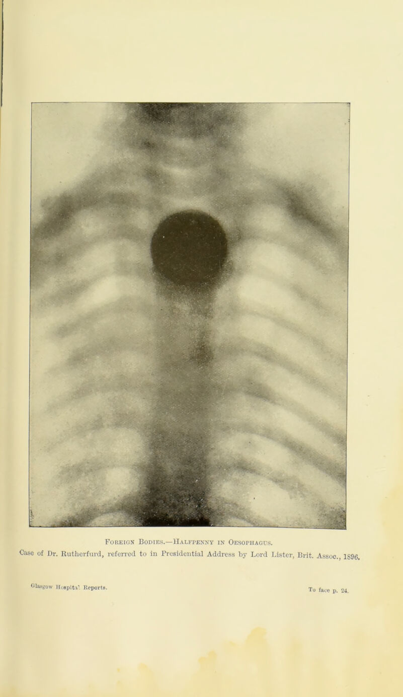 Foreign Bodies.—Halfpenny in Oesophagus. Case of Dr. Rutherfurd, referred to in Presidential Address by Lord Lister, Brit. Assoc., 1S96