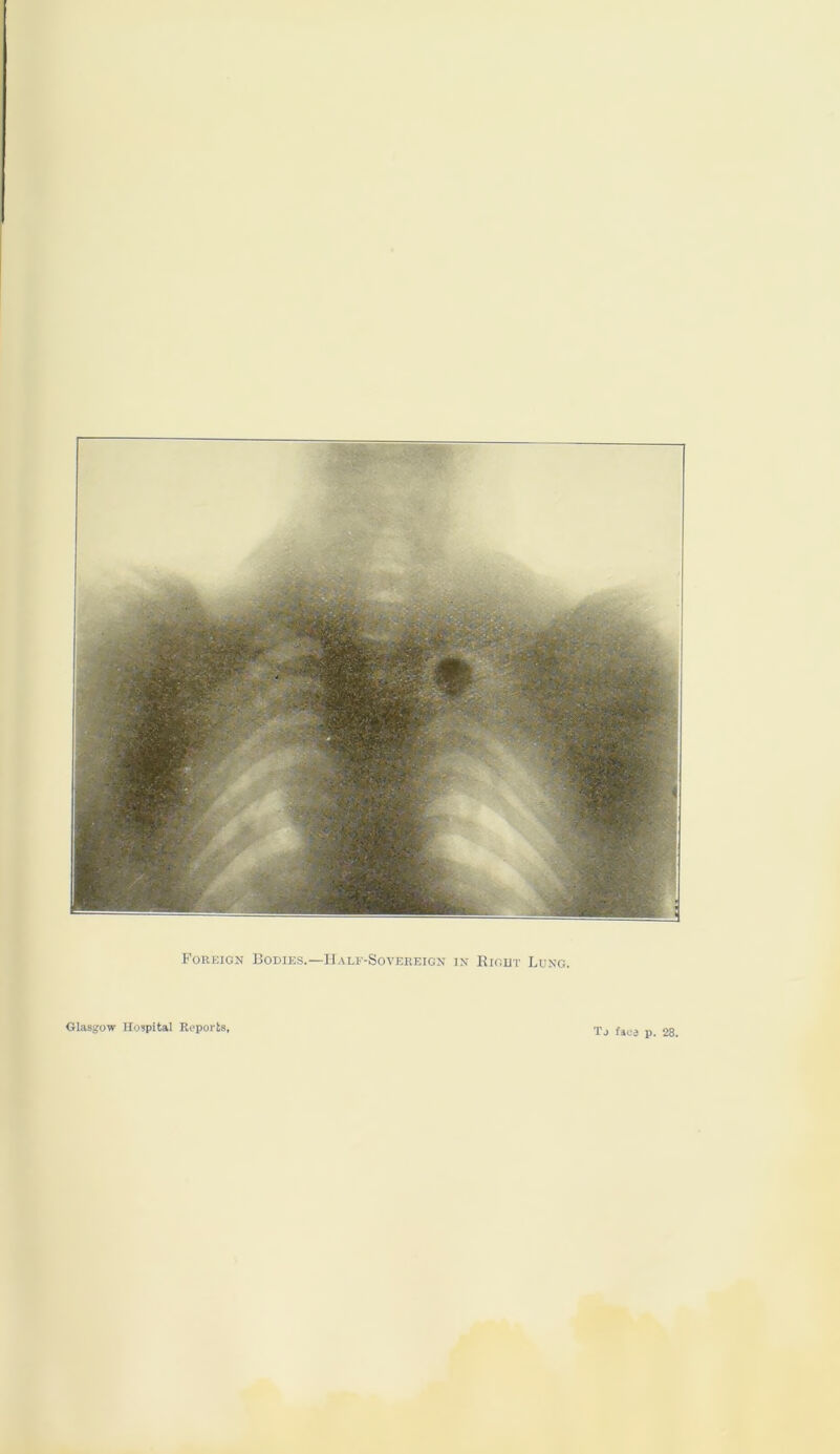 Foreign Bodies.—Half-Sovereign in Right Lung.