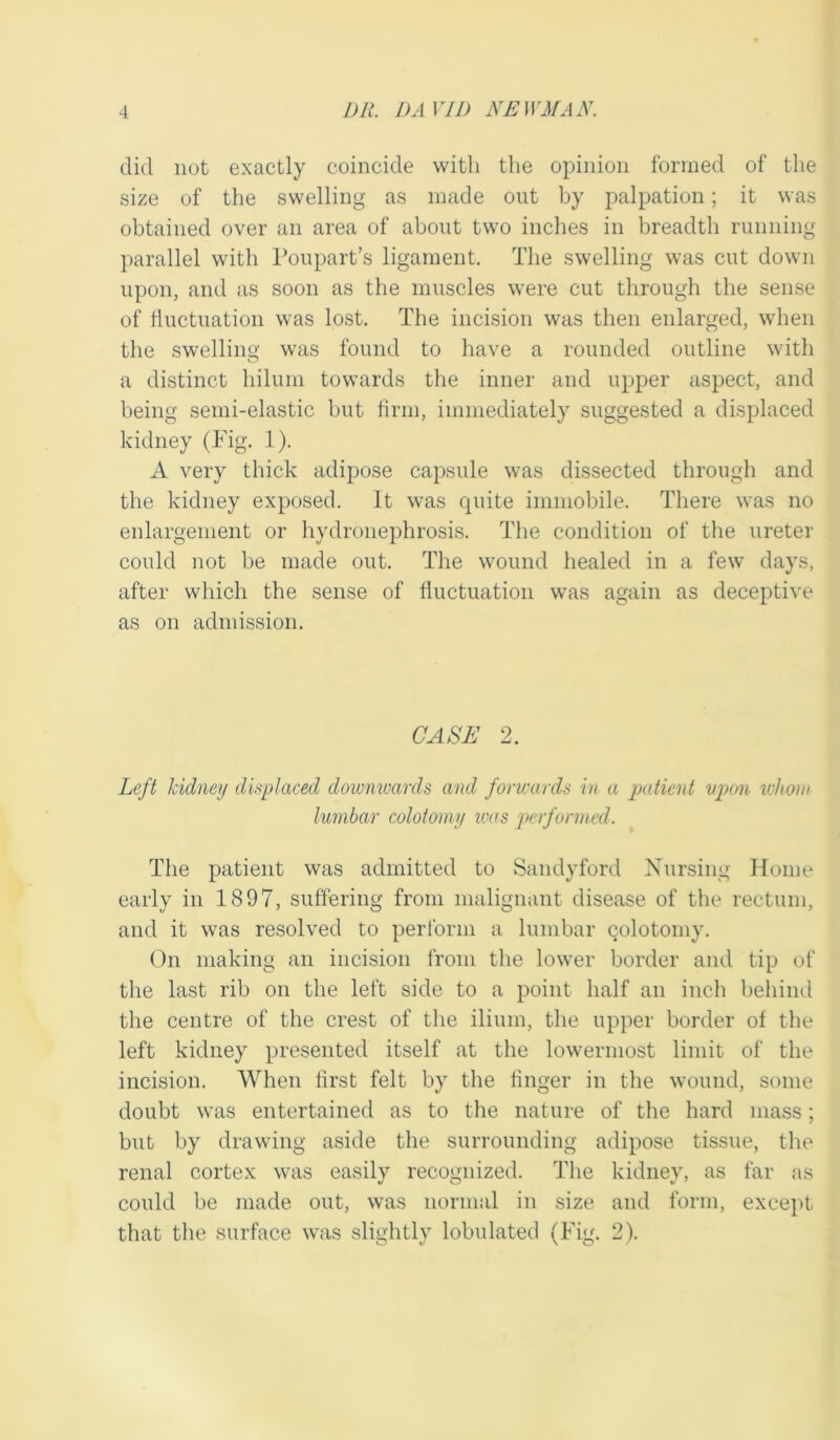 did not exactly coincide with the opinion formed of the size of the swelling as made out by palpation; it was obtained over an area of about two inches in breadth running parallel with Poupart’s ligament. The swelling was cut down upon, and as soon as the muscles were cut through the sense of fluctuation was lost. The incision was then enlarged, when the swelling was found to have a rounded outline with a distinct hilum towards the inner and upper aspect, and being semi-elastic but firm, immediately suggested a displaced kidney (Pig. 1). A very thick adipose capsule was dissected through and the kidney exposed. It was quite immobile. There was no enlargement or hydronephrosis. The condition of the ureter could not be made out. The wound healed in a few days, after which the sense of fluctuation was again as deceptive as on admission. CASE 2. Left kidney displaced downwards and forwards in a patient upon whom lumbar colotomy was performed. The patient was admitted to Sandyford Nursing Home early in 1897, suffering from malignant disease of the rectum, and it was resolved to perform a lumbar colotomy. On making an incision from the lower border and tip of the last rib on the left side to a point half an inch behind the centre of the crest of the ilium, the upper border of the left kidney presented itself at the lowermost limit of the incision. When first felt by the finger in the wound, some doubt was entertained as to the nature of the hard mass; but by drawing aside the surrounding adipose tissue, the renal cortex was easily recognized. The kidney, as far as could be made out, was normal in size and form, except that the surface was slightly lobulated (Fig. 2).