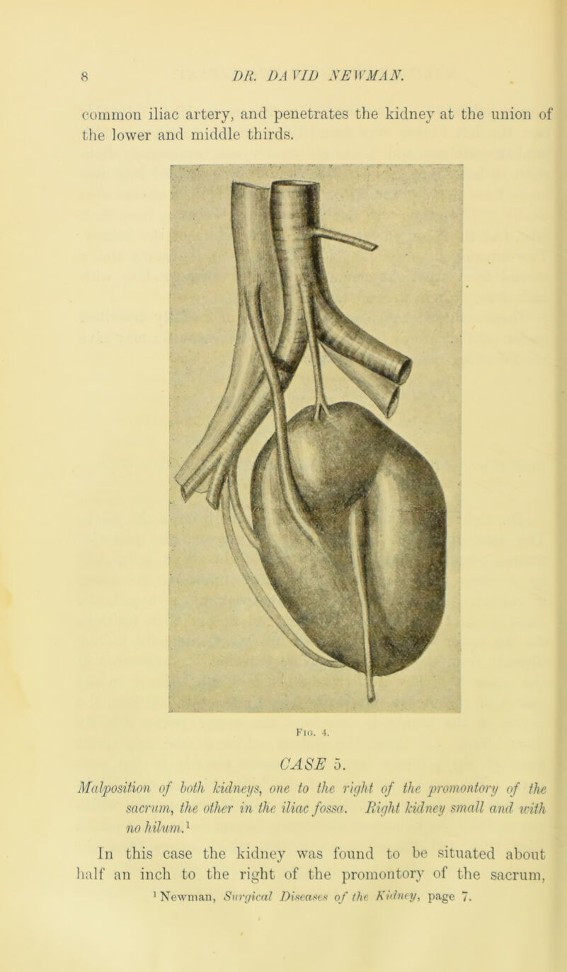 common iliac artery, and penetrates the kidney at the union of the lower and middle thirds. Fio. -1. CASE 5. Malposition of both kidneys, one to the right of the promontory of the sacrum, the other in the iliac fossa. Bight kidney small and with no hilum.1 In this case the kidney was found to be situated about half an inch to the right of the promontory of the sacrum, 1 Newman, Surgical Diseases of the Kidney, page 7.