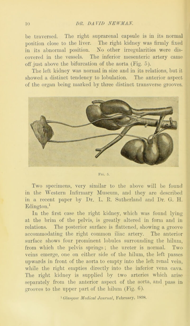 be traversed. The right suprarenal capsule is in its normal position close to the liver. The right kidney was firmly fixed in its abnormal position. No other irregularities were dis- covered in the vessels. The inferior mesenteric artery came off just above the bifurcation of the aorta (Fig. 5). The left kidney was normal in size and in its relations, but it showed a distinct tendency to lobulation. The anterior aspect of the organ being marked by three distinct transverse grooves. Fig. 5. Two specimens, very similar to the above will be found in the Western Infirmary Museum, and they are described in a recent paper by Dr. L. E. Sutherland and Dr. G. H. Ellington.1 In the first case the right kidney, which was found lying at the brim of the pelvis, is greatly altered in form and in relations. The posterior surface is flattened, showing a groove accommodating the right common iliac artery. The anterior surface shows four prominent lobules surrounding the hilum, from which the pelvis springs; the ureter is normal. Two veins emerge, one on either side of the hilum, the left passes upwards in front of the aorta to empty into the left renal vein, while the right empties directly into the inferior vena cava. The right kidney is supplied by two arteries which arise separately from the anterior aspect of the aorta, and pass in grooves to the upper part of the hilum (Fig. 6). 1 Glanr/ow Medical Journal, February, 189S.