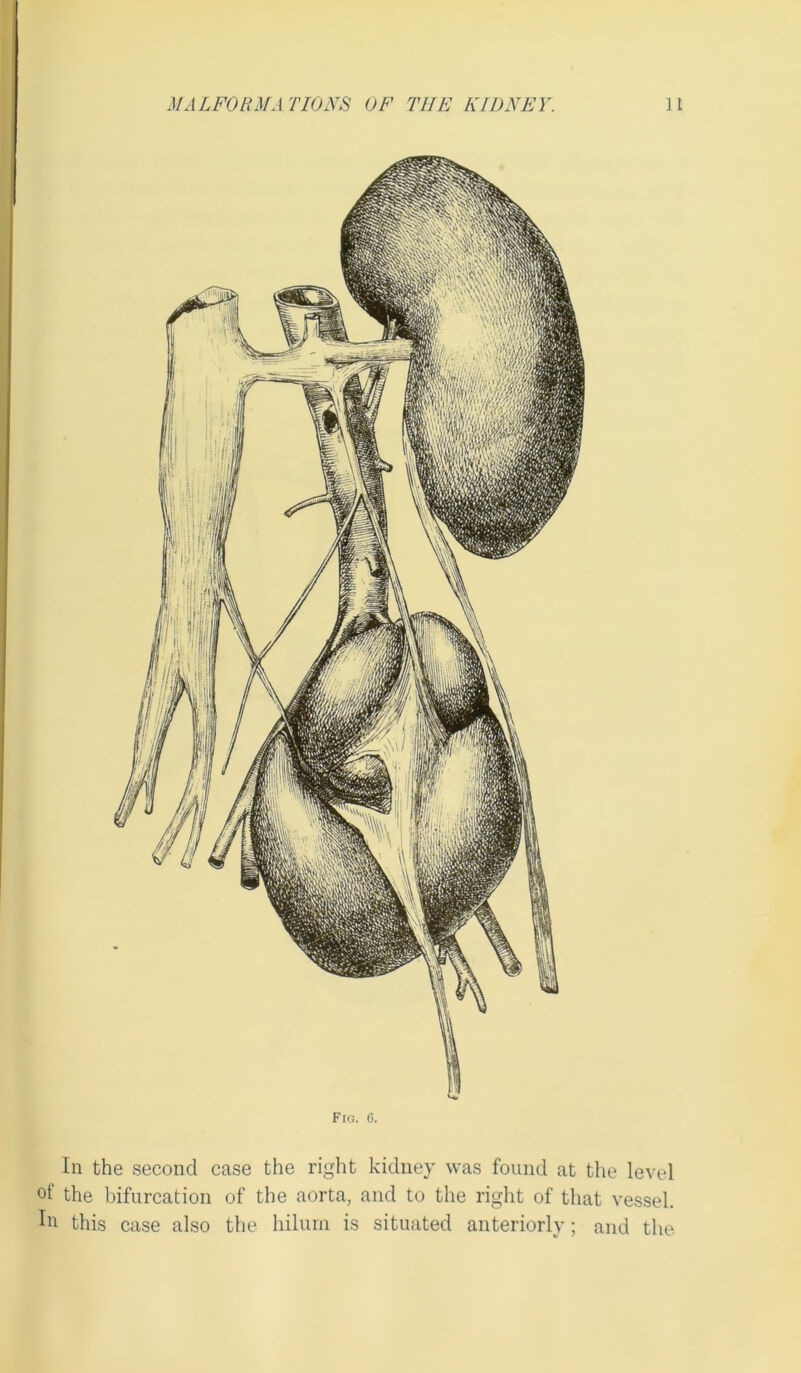Fig. 6. In the second case the right kidney was found at the level °f the bifurcation of the aorta, and to the right of that vessel. In this case also the hilurn is situated anteriorly; and the