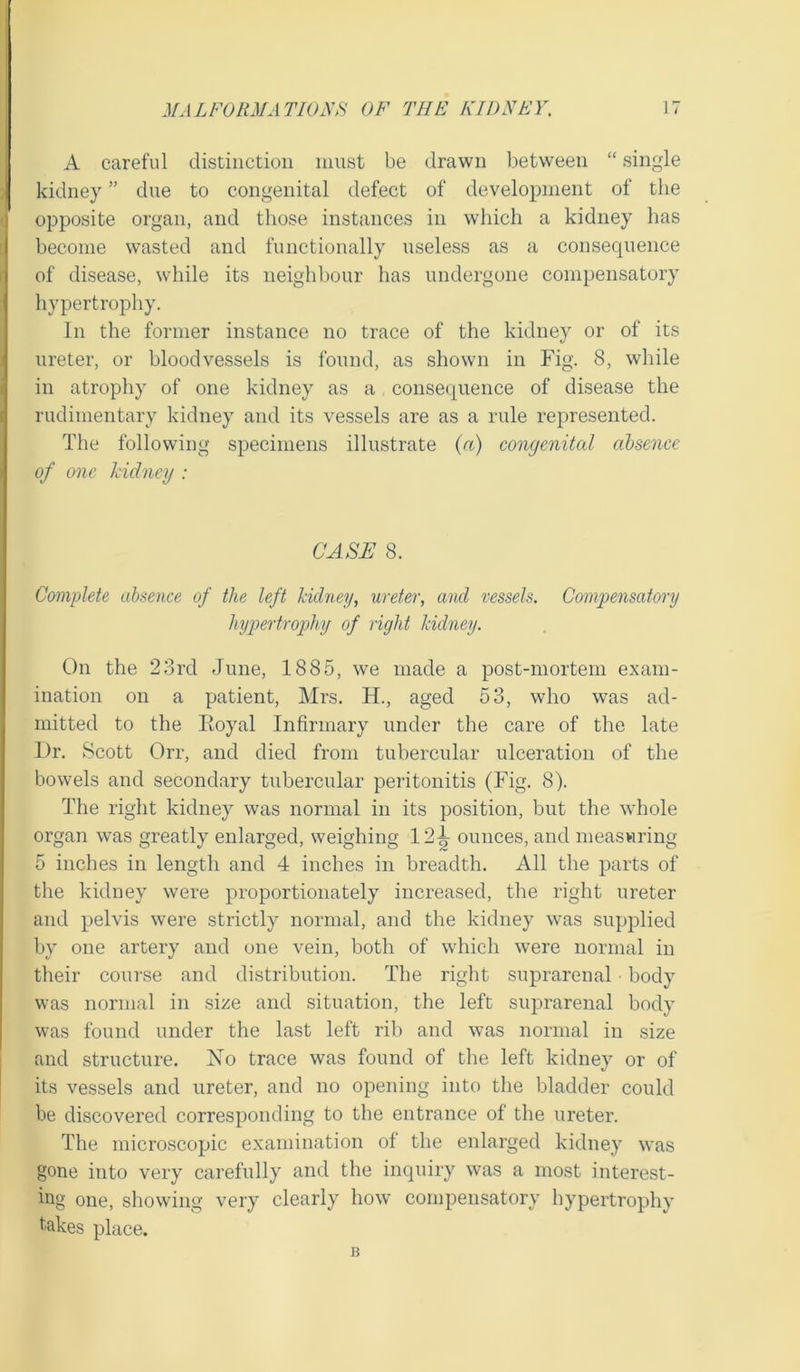 A careful distinction must be drawn between “ single kidney ” due to congenital defect of development of the opposite organ, and those instances in which a kidney has become wasted and functionally useless as a consequence of disease, while its neighbour has undergone compensatory hypertrophy. In the former instance no trace of the kidney or of its ureter, or bloodvessels is found, as shown in Fig. 8, while in atrophy of one kidney as a consequence of disease the rudimentary kidney and its vessels are as a rule represented. The following specimens illustrate (a) congenital absence of one kiclney : CASE 8. Complete absence of the left kiclney, ureter, and vessels. Compensatory hypertrophy of right kidney. On the 23rd June, 1885, we made a post-mortem exam- ination on a patient, Mrs. H., aged 53, who was ad- mitted to the Eoyal Infirmary under the care of the late Dr. Scott Orr, and died from tubercular ulceration of the bowels and secondary tubercular peritonitis (Fig. 8). The right kidney was normal in its position, but the whole organ was greatly enlarged, weighing 12^ ounces, and measuring 5 inches in length and 4 inches in breadth. All the parts of the kidney were proportionately increased, the right ureter and pelvis were strictly normal, and the kidney was supplied by one artery and one vein, both of which were normal in their course and distribution. The right suprarenal • body was normal in size and situation, the left suprarenal body was found under the last left rib and was normal in size and structure. No trace was found of the left kidney or of its vessels and ureter, and no opening into the bladder could be discovered corresponding to the entrance of the ureter. The microscopic examination of the enlarged kidney was gone into very carefully and the inquiry was a most interest- ing one, showing very clearly how compensatory hypertrophy fakes place. B