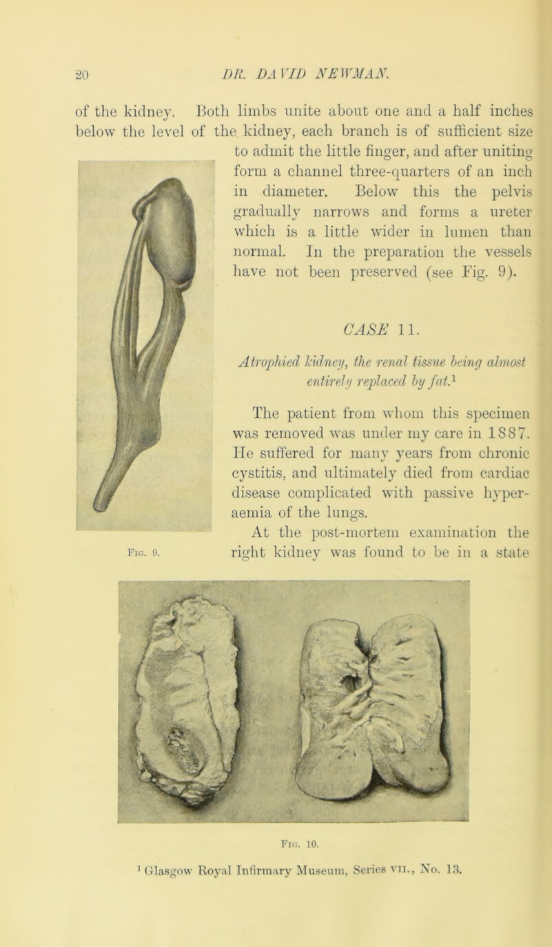 of the kidney. Both limbs unite about one and a half inches below the level of the kidney, each branch is of sufficient size to admit the little finger, and after uniting form a channel three-quarters of an inch in diameter. Below this the pelvis gradually narrows and forms a ureter which is a little wider in lumen than normal. In the preparation the vessels have not been preserved (see Fig. 9). CASE 11. Fig. 9. Atrophied kidney, the renal tissue being almost entirely replaced by fat.1 The patient from whom this specimen was removed was under my care in 1887. Tie suffered for many years from chronic cystitis, and ultimately died from cardiac disease complicated with passive liyper- aemia of the lungs. At the post-mortem examination the right kidney was found to be in a state Fig. 10.