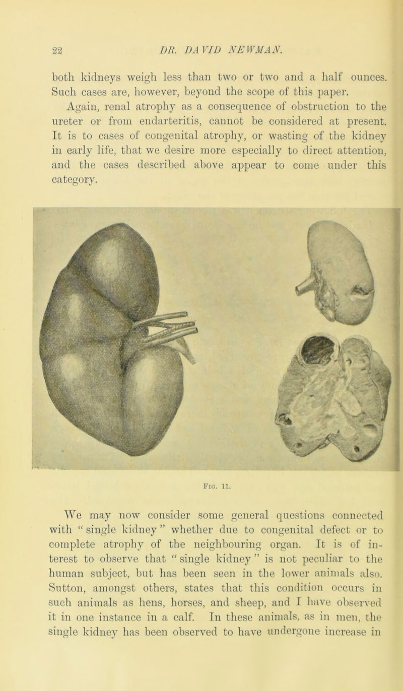 both kidneys weigh less than two or two and a half ounces. Such cases are, however, beyond the scope of this paper. Again, renal atrophy as a consequence of obstruction to the ureter or from endarteritis, cannot be considered at present. It is to cases of congenital atrophy, or wasting of the kidney in early life, that we desire more especially to direct attention, and the cases described above appear to come under this category. FlO. 11. We may now consider some general questions connected with “ single kidney ” whether due to congenital defect or to complete atrophy of the neighbouring organ. It is of in- terest to observe that “ single kidney ” is not peculiar to the human subject, but has been seen in the lower animals also. Sutton, amongst others, states that this condition occurs in such animals as liens, horses, and sheep, and I have observed it in one instance in a calf. In these animals, as in men, the single kidney has been observed to have undergone increase in