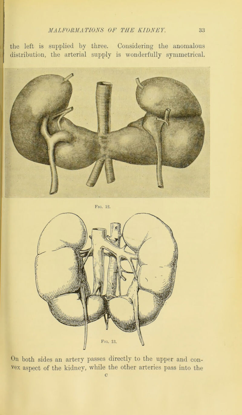 the left is supplied by three. Considering the anomalous distribution, the arterial supply is wonderfully symmetrical. On both sides an artery passes directly to the upper and con- vex aspect of the kidney, while the other arteries pass into the c