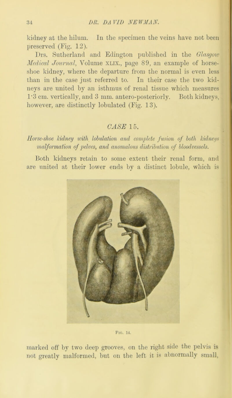 kidney at the hilum. In the specimen the veins have not been preserved (Fig. 12). Drs. Sutherland and Edington published in the Glasgow Medical Journal, Volume xlix., page 89, an example of horse- shoe kidney, where the departure from the normal is even less than in the case just referred to. In their case the two kid- neys are united by an isthmus of renal tissue which measures 1*3 cm. vertically, and 3 mm. antero-posteriorly. Both kidneys, however, are distinctly lobulated (Fig. 13). CASE 15. Horse-shoe kidney -with lobulation and complete fusion of both kidneys . malformation of 'pelves, and anomalous distribution of bloodvessels. Both kidneys retain to some extent their renal form, and are united at their lower ends by a distinct lobule, which is Fig. 14. marked off by two deep grooves, on the right side the pelvis is not greatly malformed, but on the left it is abnormally small,