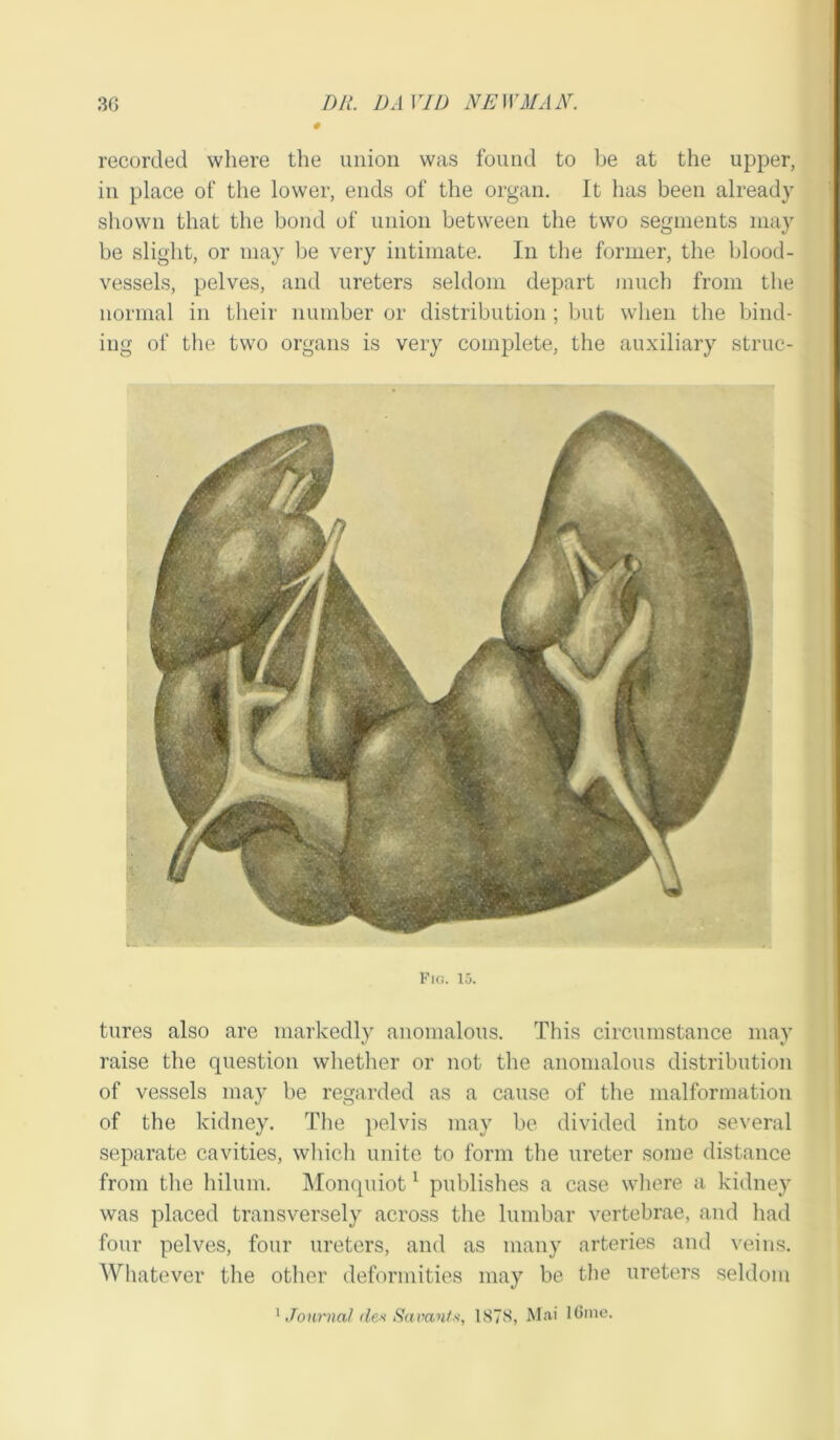 0 recorded where the union was found to be at the upper, in place of the lower, ends of the organ. It has been already shown that the bond of union between the two segments may be slight, or may be very intimate. In the former, the blood- vessels, pelves, and ureters seldom depart much from the normal in their number or distribution ; but when the bind- ing of the two organs is very complete, the auxiliary struc- tures also are markedly anomalous. This circumstance may raise the question whether or not the anomalous distribution of vessels may be regarded as a cause of the malformation of the kidney. The pelvis may be divided into several separate cavities, which unite to form the ureter some distance from the hilum. Monquiot1 publishes a case where a kidney was placed transversely across the lumbar vertebrae, and had four pelves, four ureters, and as many arteries and veins. Whatever the other deformities may be the ureters seldom 1 Journal den Savant*, 1878, Mai lGme.