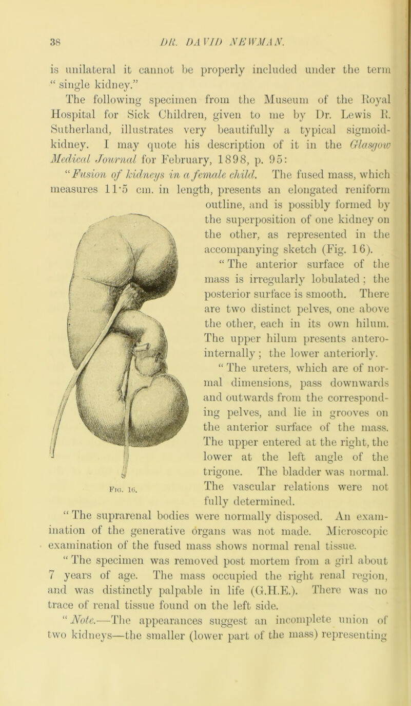 is unilateral it cannot be properly included under the term “ single kidney.” The following specimen from the Museum of the Royal Hospital for Sick Children, given to me by Dr. Lewis R. Sutherland, illustrates very beautifully a typical sigmoid- kidney. I may quote his description of it in the Glasgow Medical Journal for February, 1898, p. 95: “ Fusion of kidneys in a female child. The fused mass, which measures ll’o cm. in length, presents an elongated reniform outline, and is possibly formed by the superposition of one kidney on the other, as represented in the accompanying sketch (Fig. 16). “ The anterior surface of the mass is irregularly lobulated ; the posterior surface is smooth. There are two distinct pelves, one above the other, each in its own hilum. The upper hilum presents antero- internally ; the lower anteriorly. “ The ureters, which are of nor- mal dimensions, pass downwards and outwards from the correspond- ing pelves, and lie in grooves on the anterior surface of the mass. The upper entered at the right, the lower at the left angle of the trigone. The bladder was normal. fig. io. The vascular relations were not fully determined. “ The suprarenal bodies were normally disposed. An exam- ination of the generative drgans was not made. Microscopic examination of the fused mass shows normal renal tissue. “ The specimen was removed post mortem from a girl about 7 years of age. The mass occupied the right renal region, and was distinctly palpable in life (G.H.E.). There was no trace of renal tissue found on the left side. “ Note.—The appearances suggest an incomplete union of two kidneys—the smaller (lower part of the mass) representing